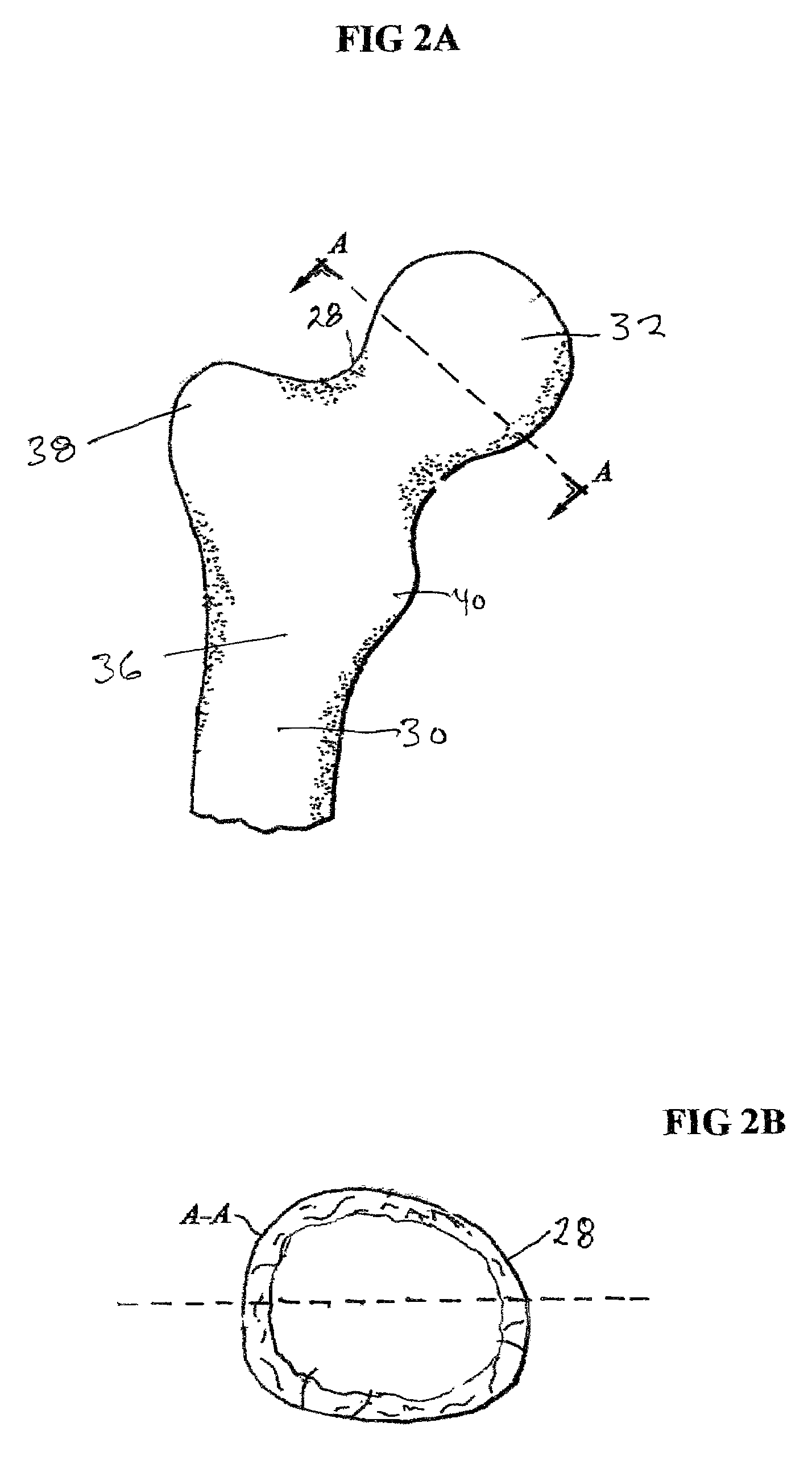 Femoral head calcar loading prosthesis