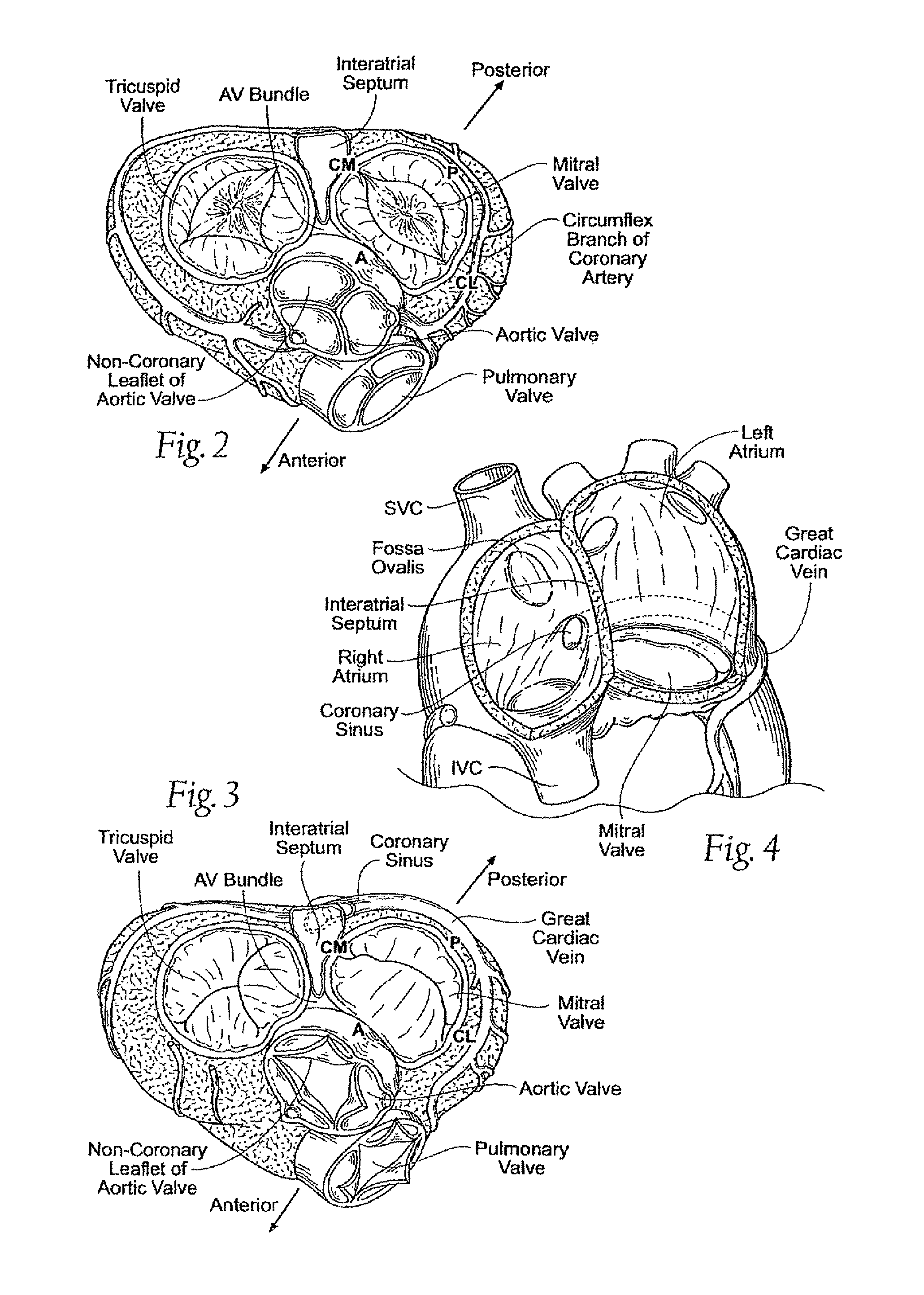 Quick-release annuloplasty ring holder