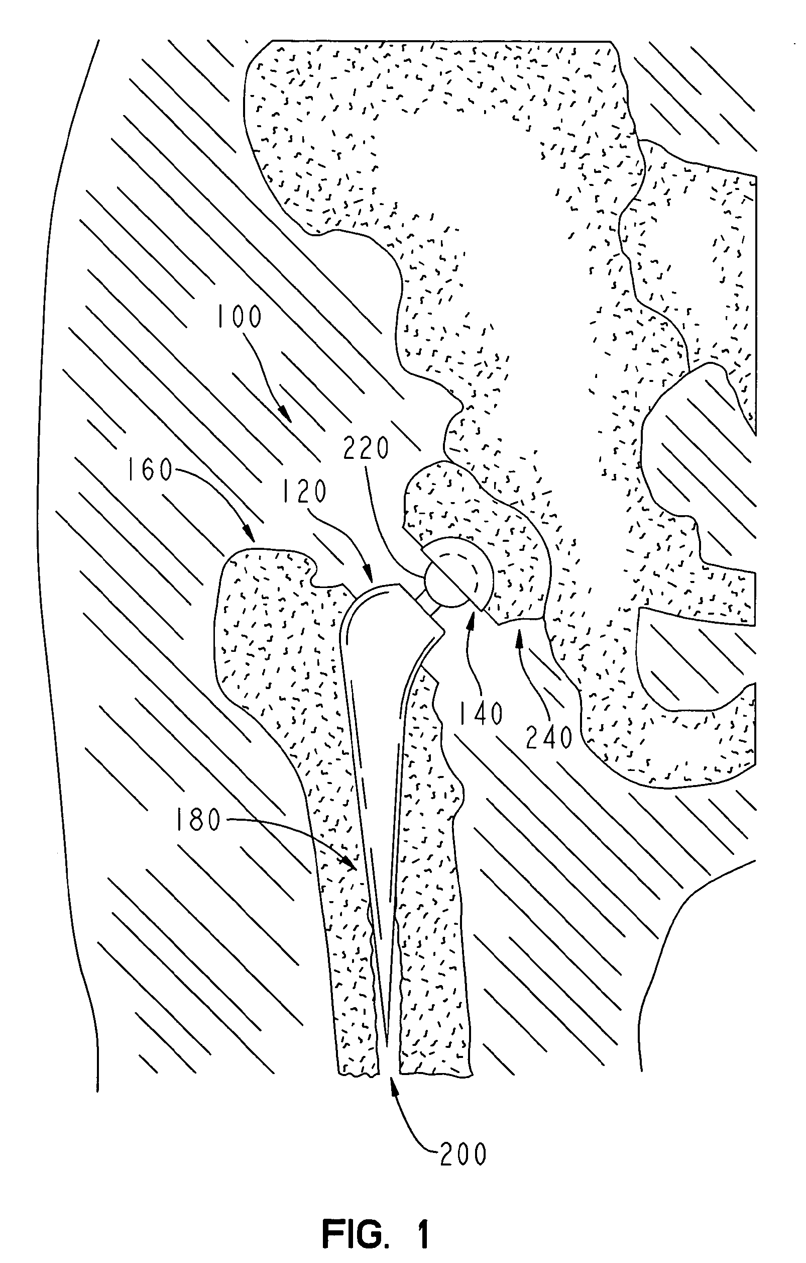 Method for making a metal-backed acetabular implant