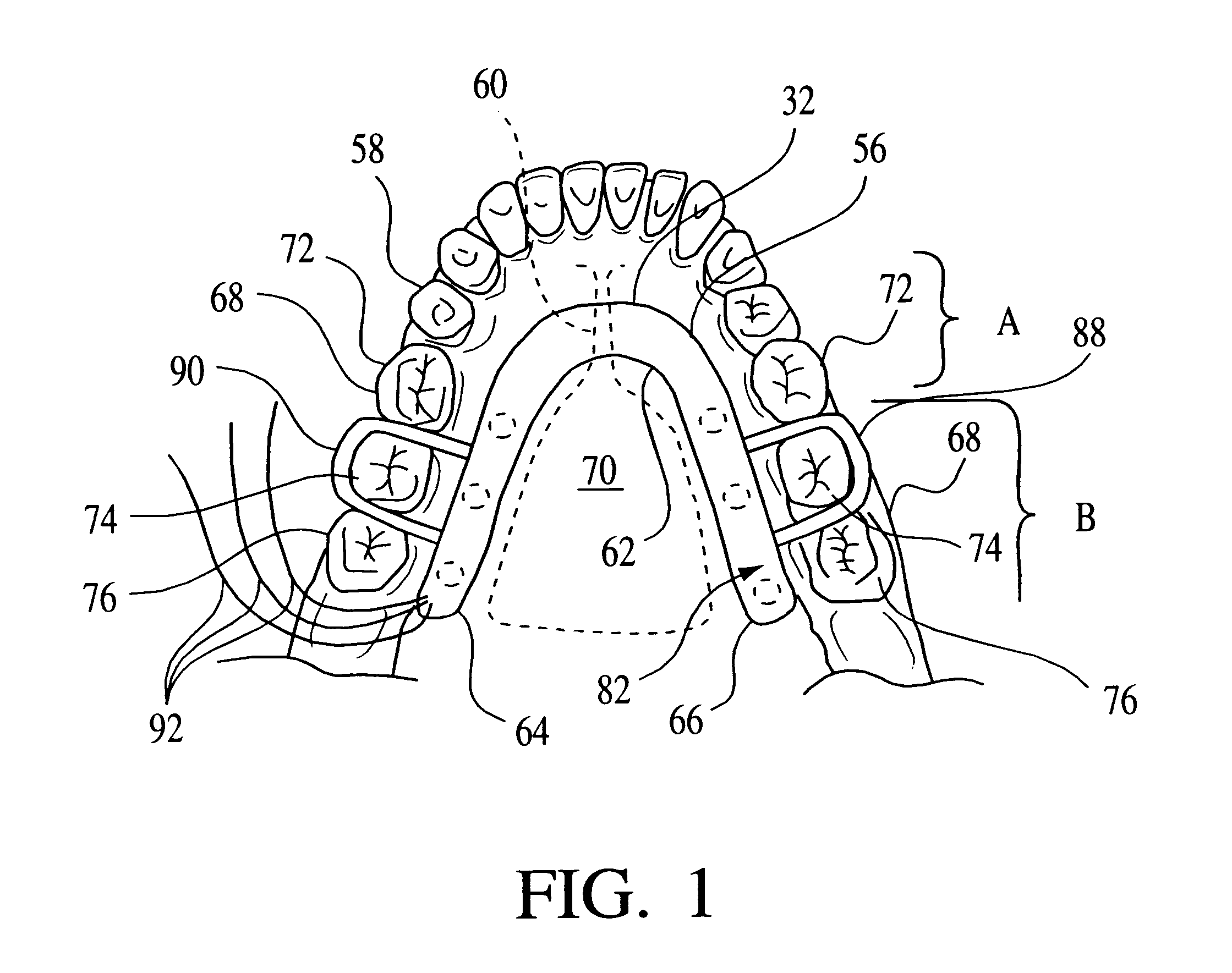 Intraoral electromuscular stimulation device and method