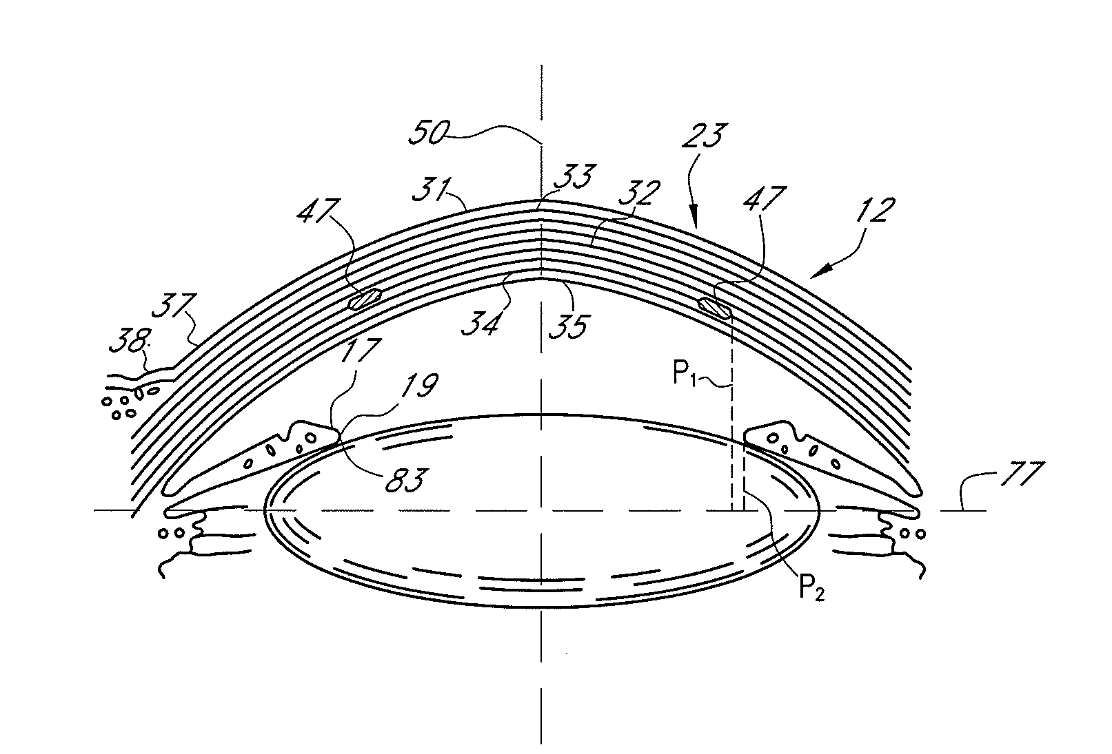 Opaque corneal insert for refractive correction