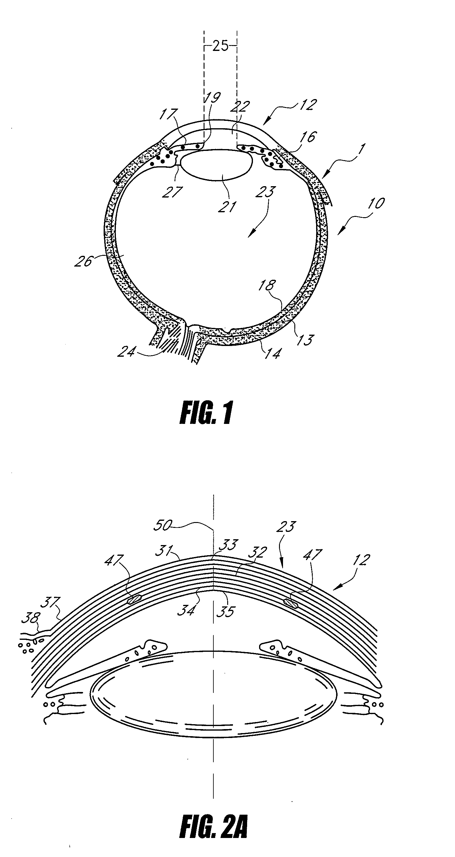 Opaque corneal insert for refractive correction