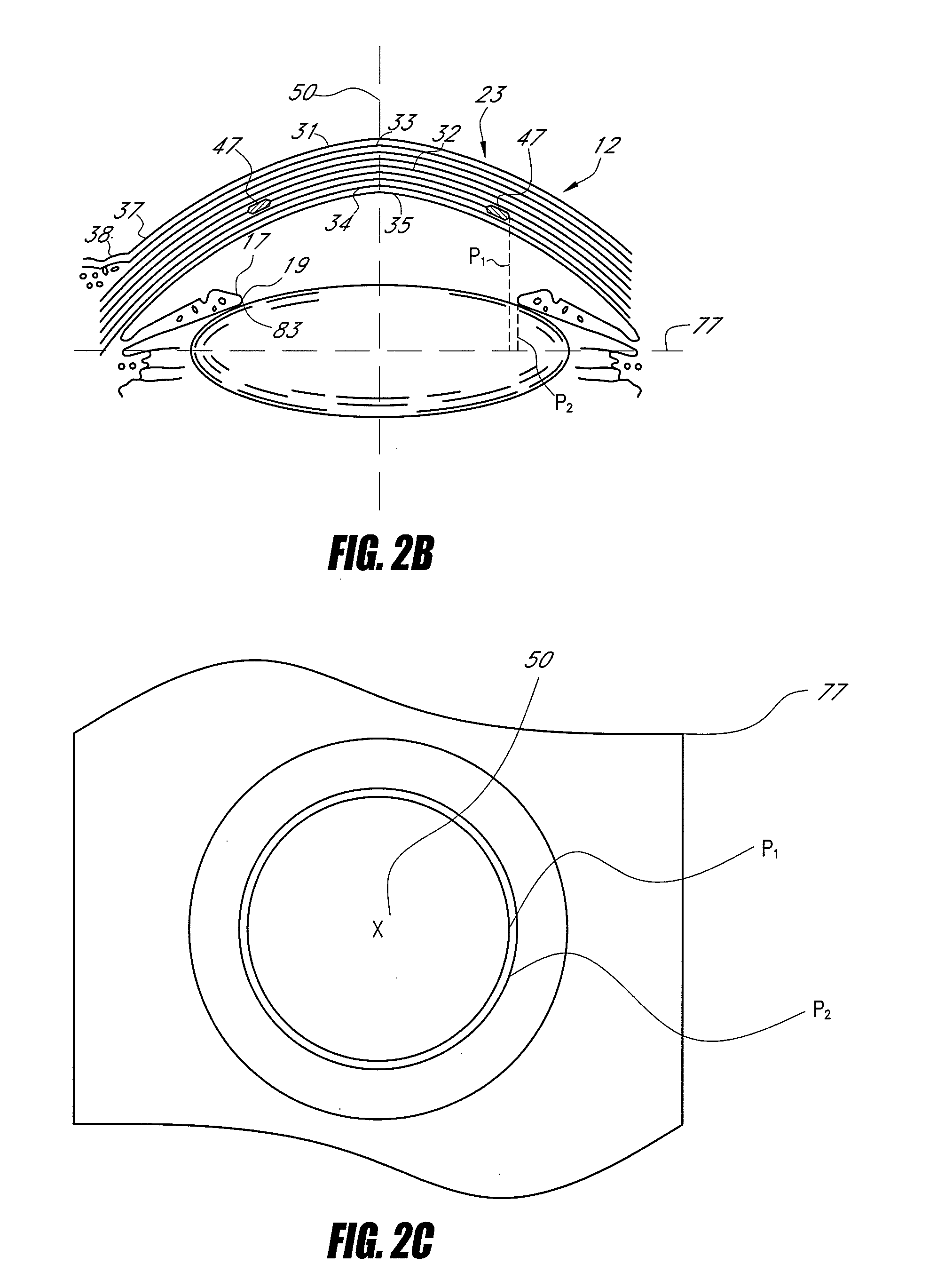 Opaque corneal insert for refractive correction