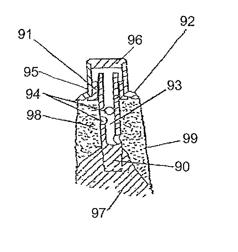 Method for enlarging a jaw bone using a hollow dental implant having a side perforation