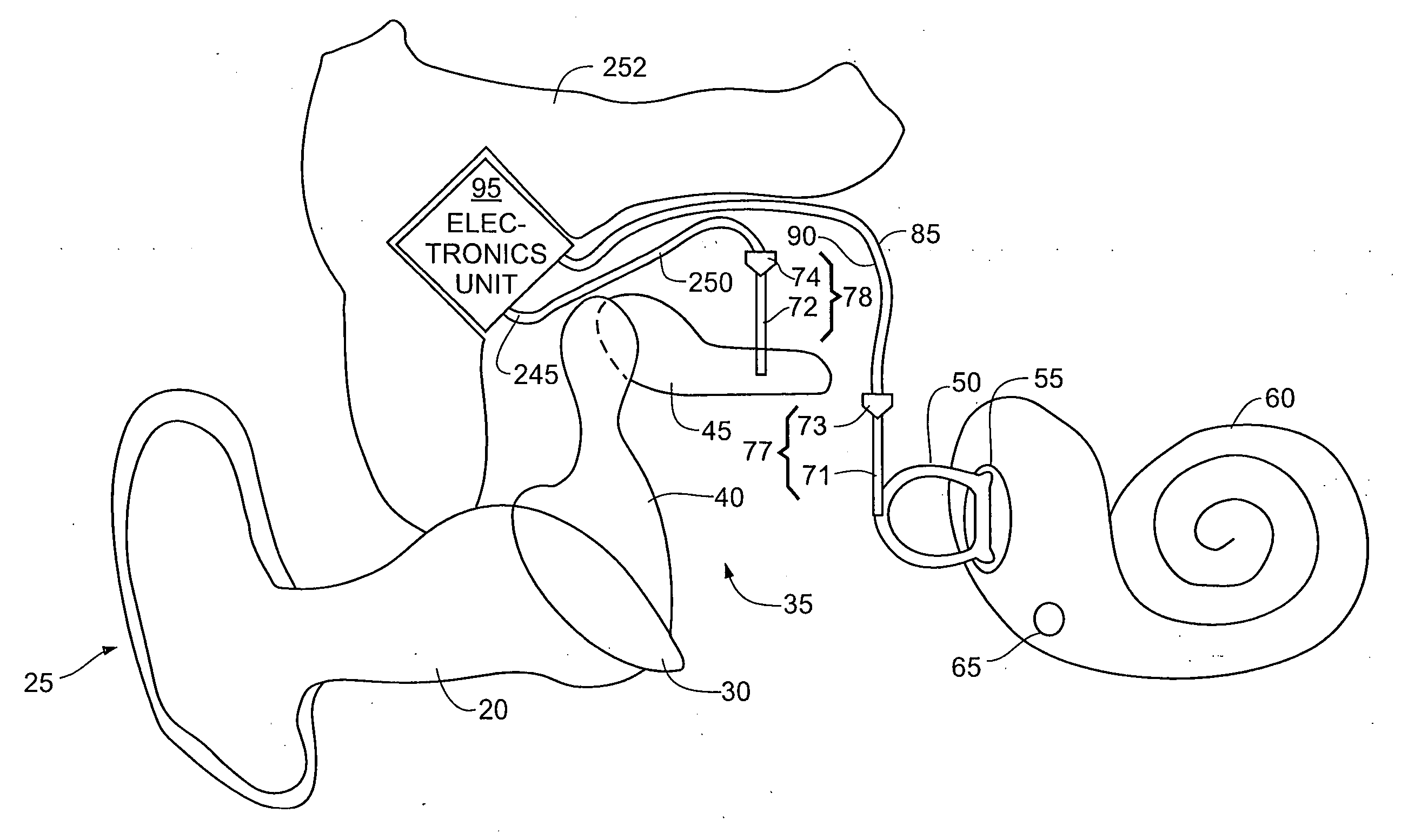 Method and apparatus for minimally invasive placement of sensing and driver assemblies to improve hearing loss