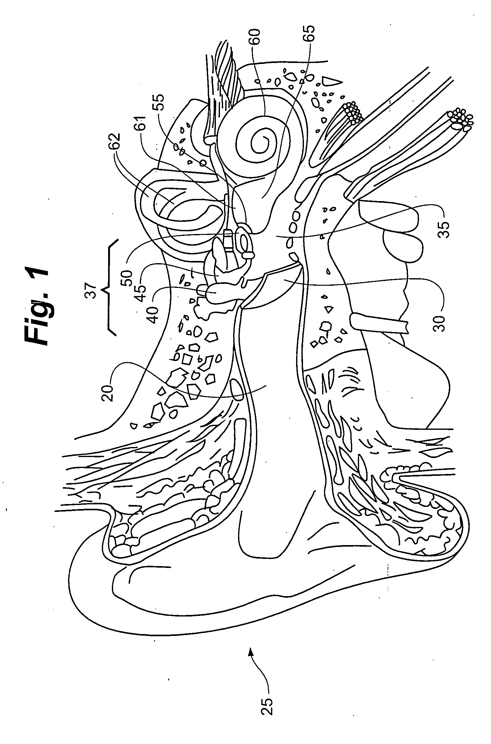 Method and apparatus for minimally invasive placement of sensing and driver assemblies to improve hearing loss