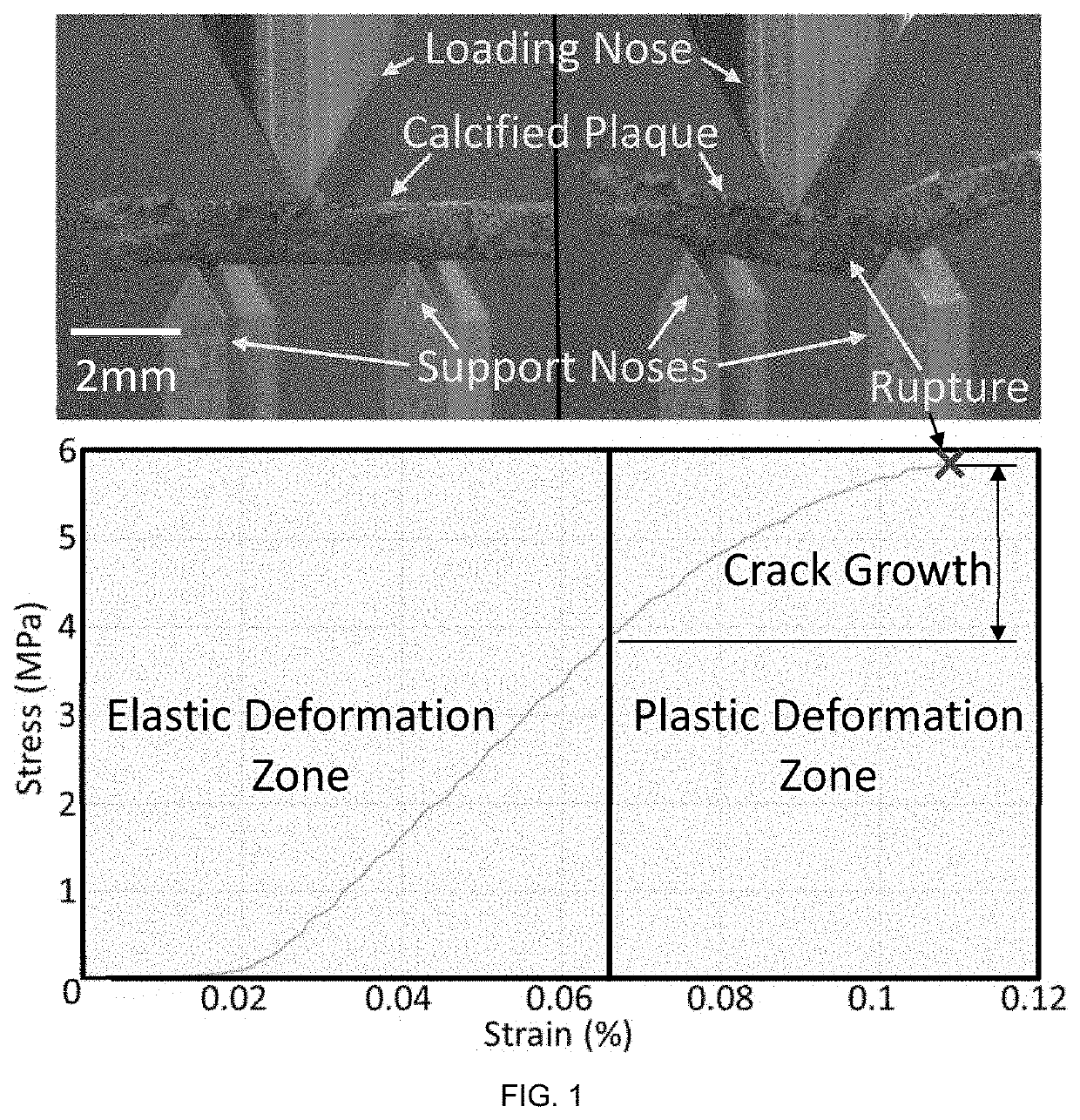 System for effecting and controlling oscillatory pressure within balloon catheters for fatigue fracture of calculi