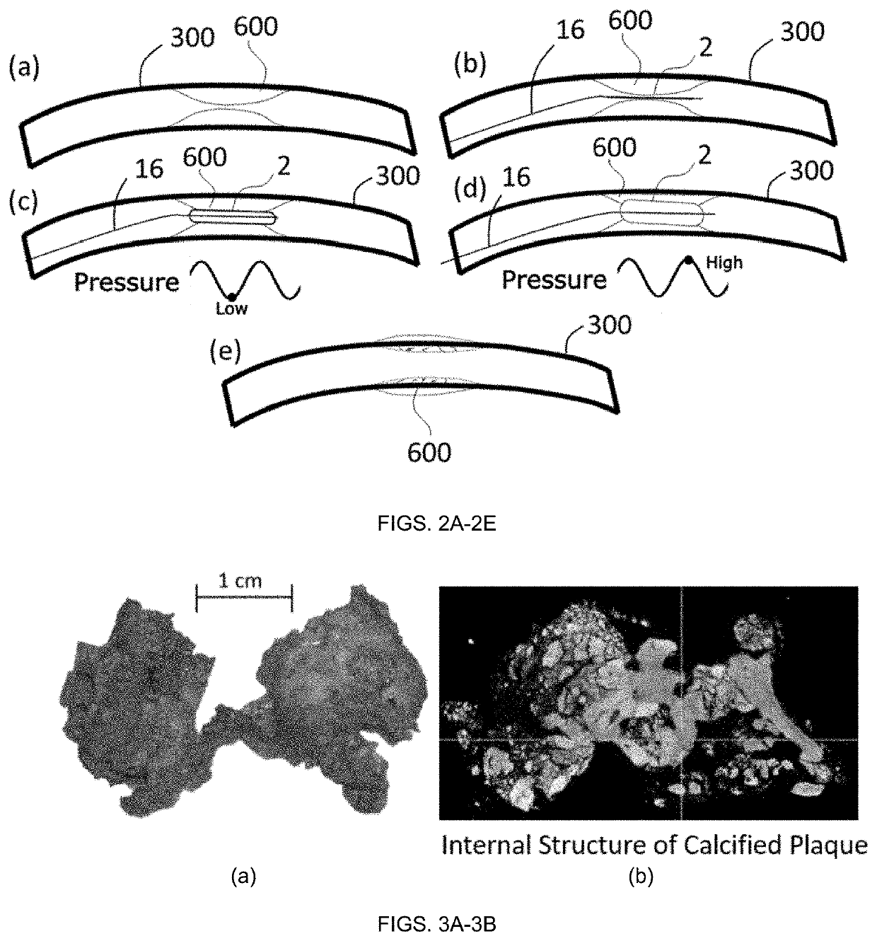 System for effecting and controlling oscillatory pressure within balloon catheters for fatigue fracture of calculi