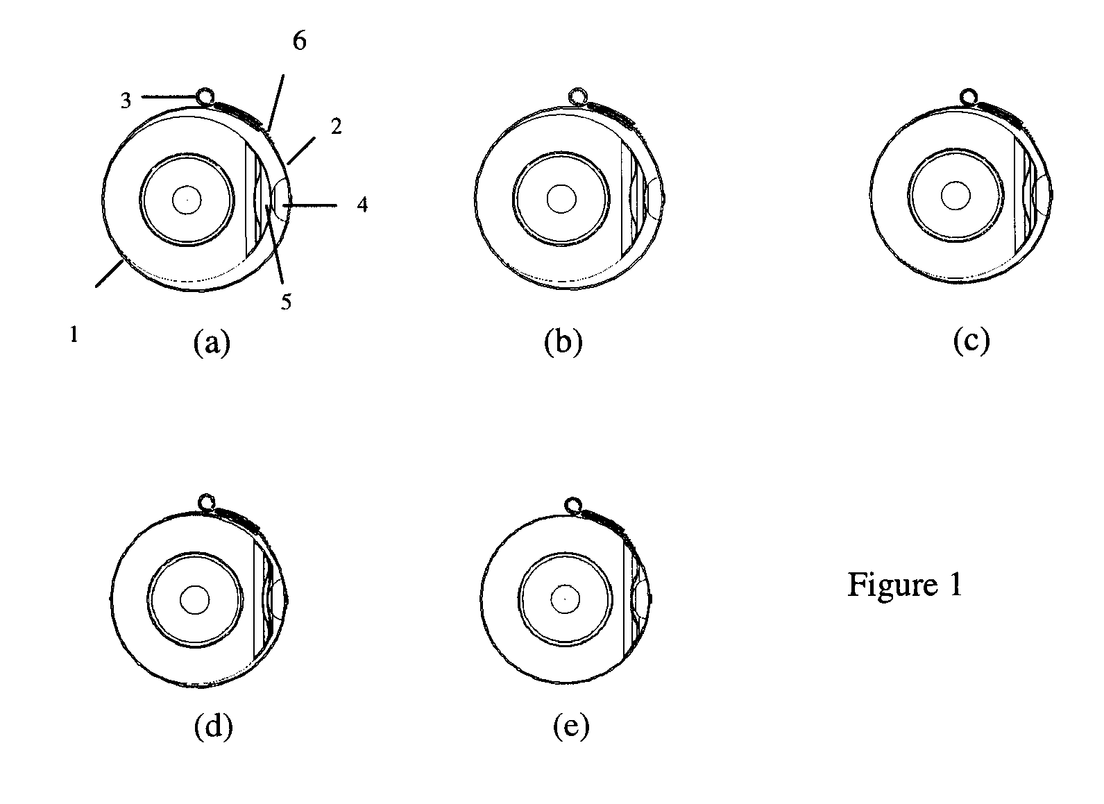 Heat Shrink Scleral Band With Custom-Made Buckle For Retinal Detachment Surgery