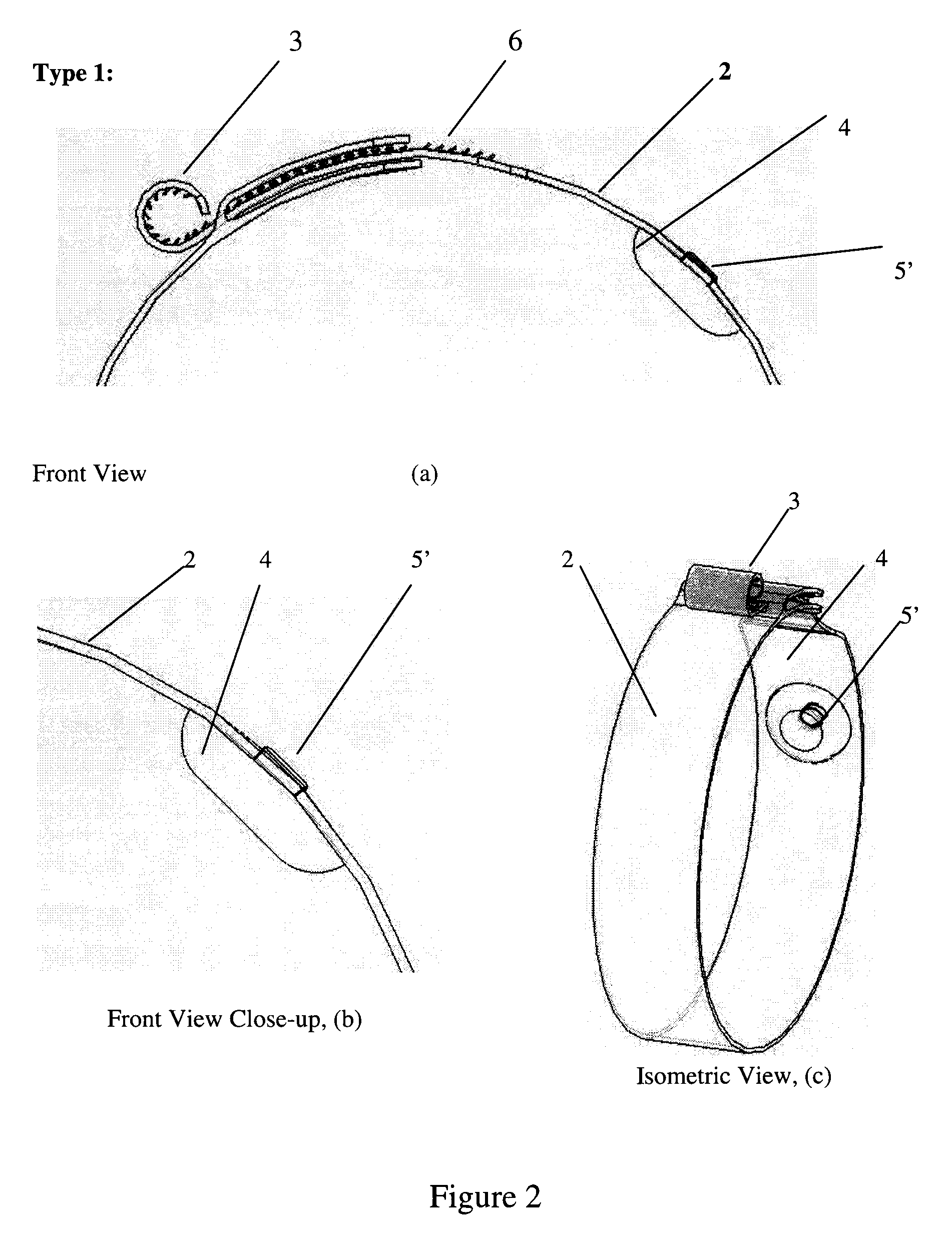 Heat Shrink Scleral Band With Custom-Made Buckle For Retinal Detachment Surgery