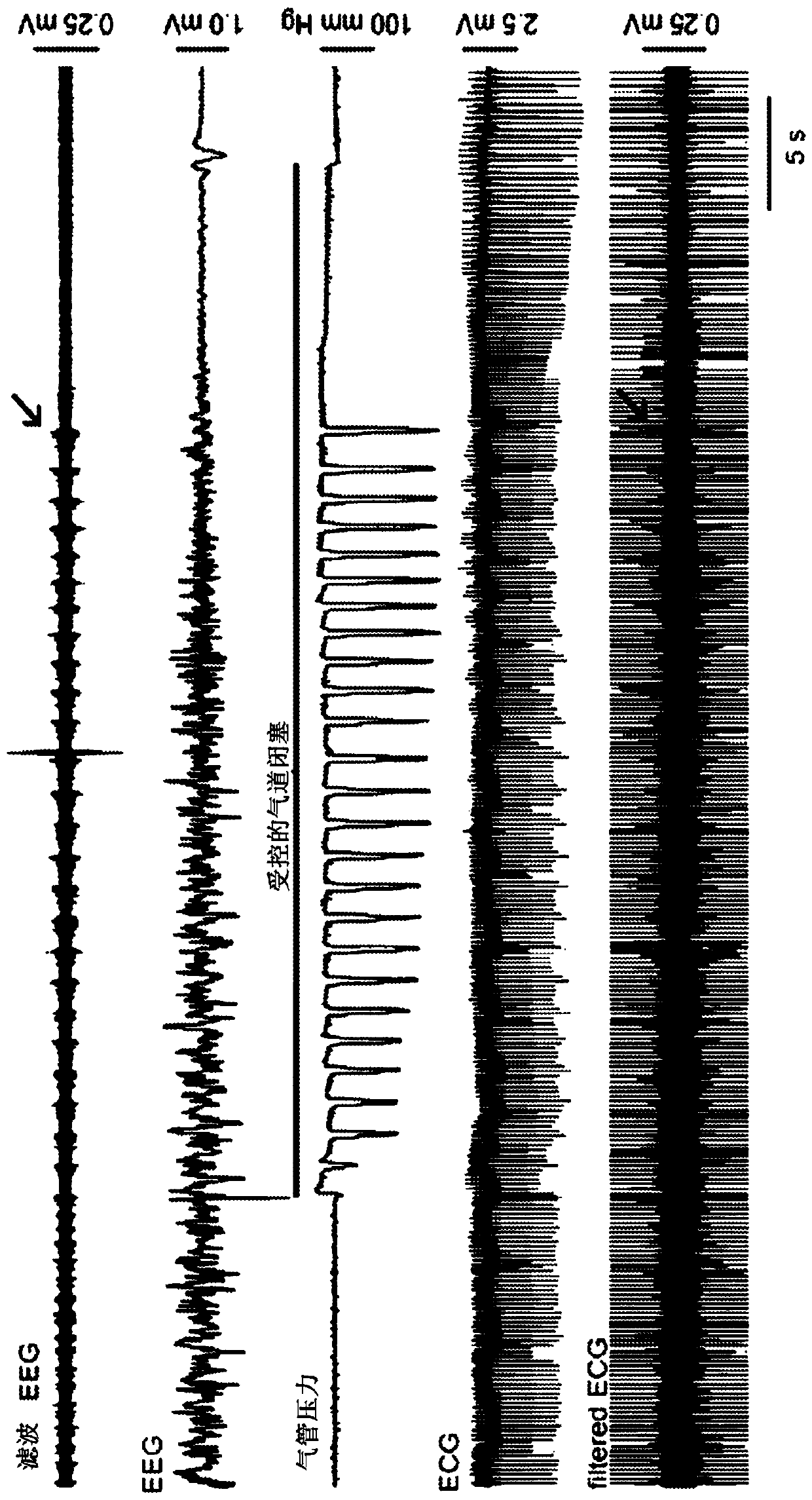 System, method and biomarkers for airway obstruction