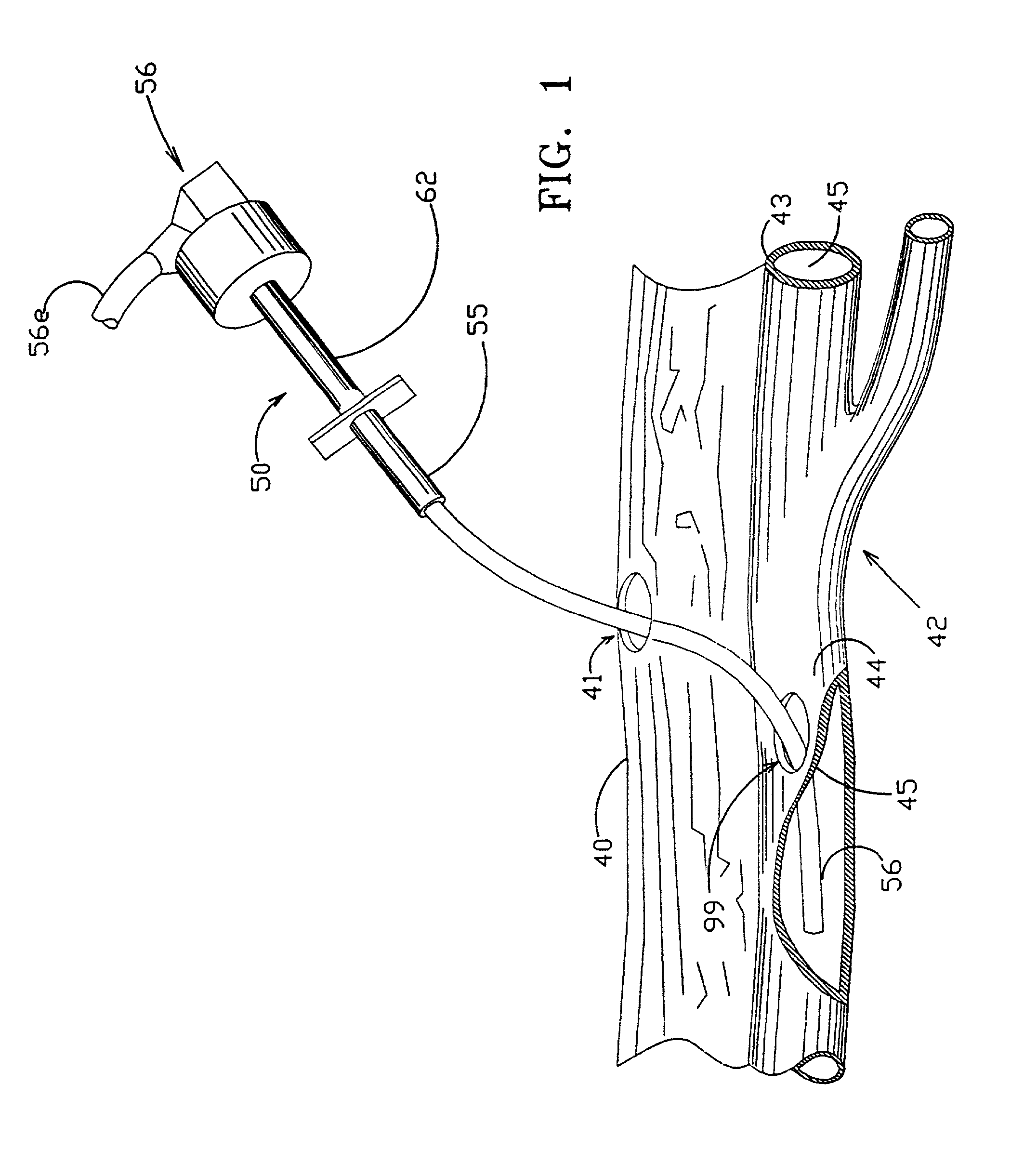 Apparatus and method for positive closure of an internal tissue membrane opening