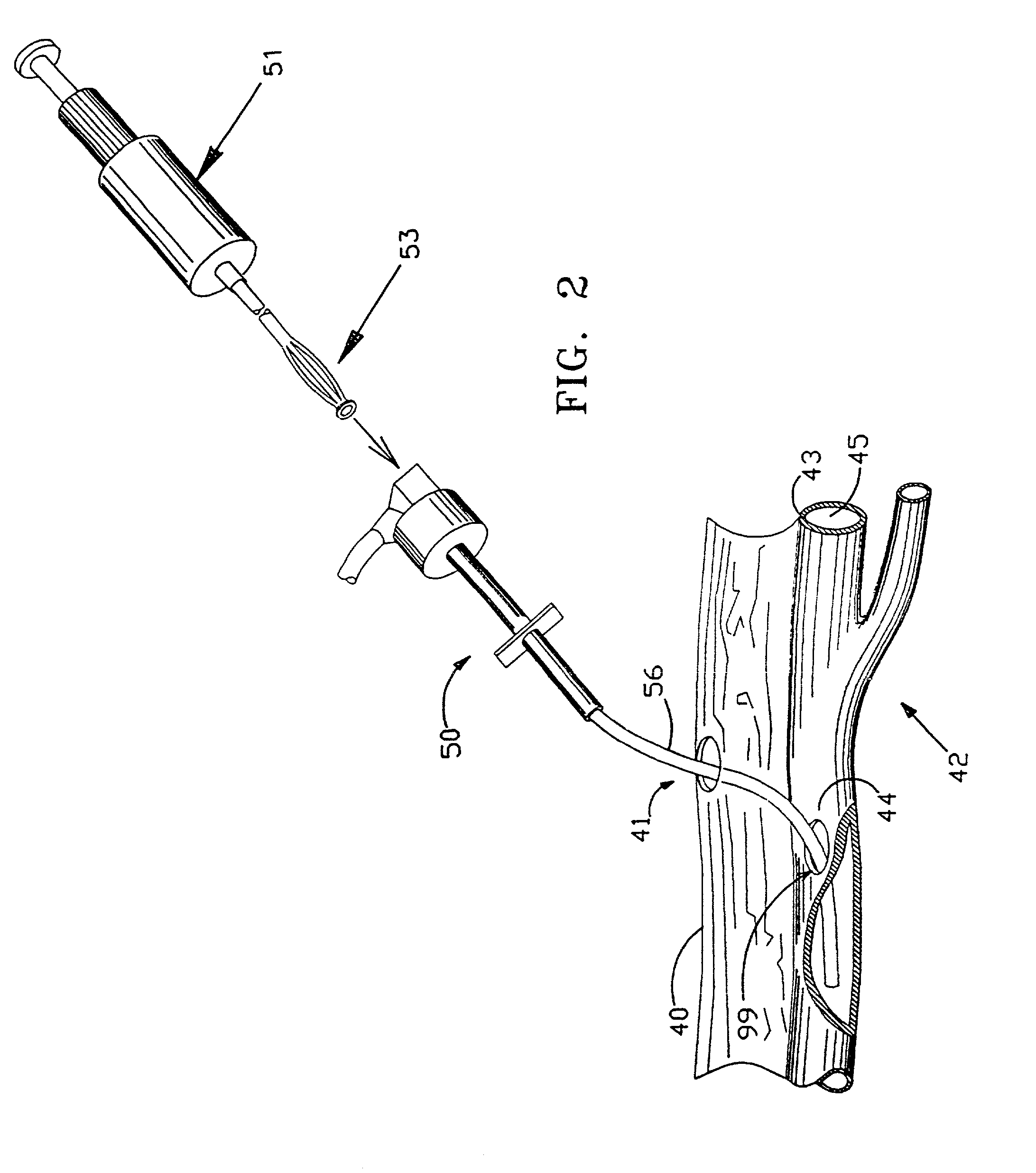 Apparatus and method for positive closure of an internal tissue membrane opening