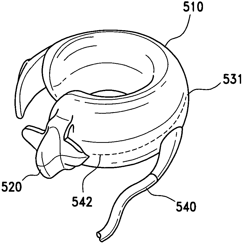 Gastric band