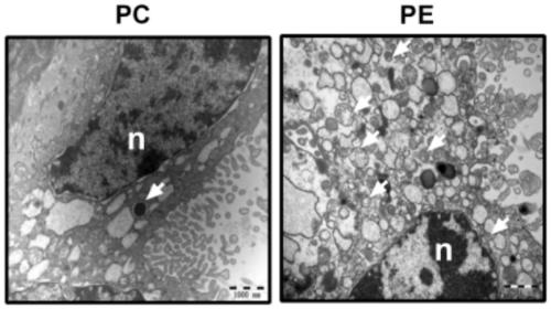 Marker gene for clinical risk assessment of preeclampsia and application of marker gene