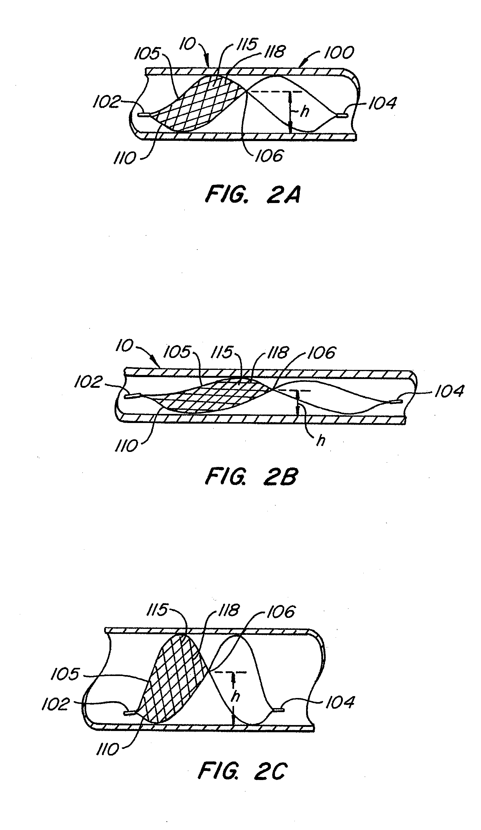 Endoluminal Filter With Fixation