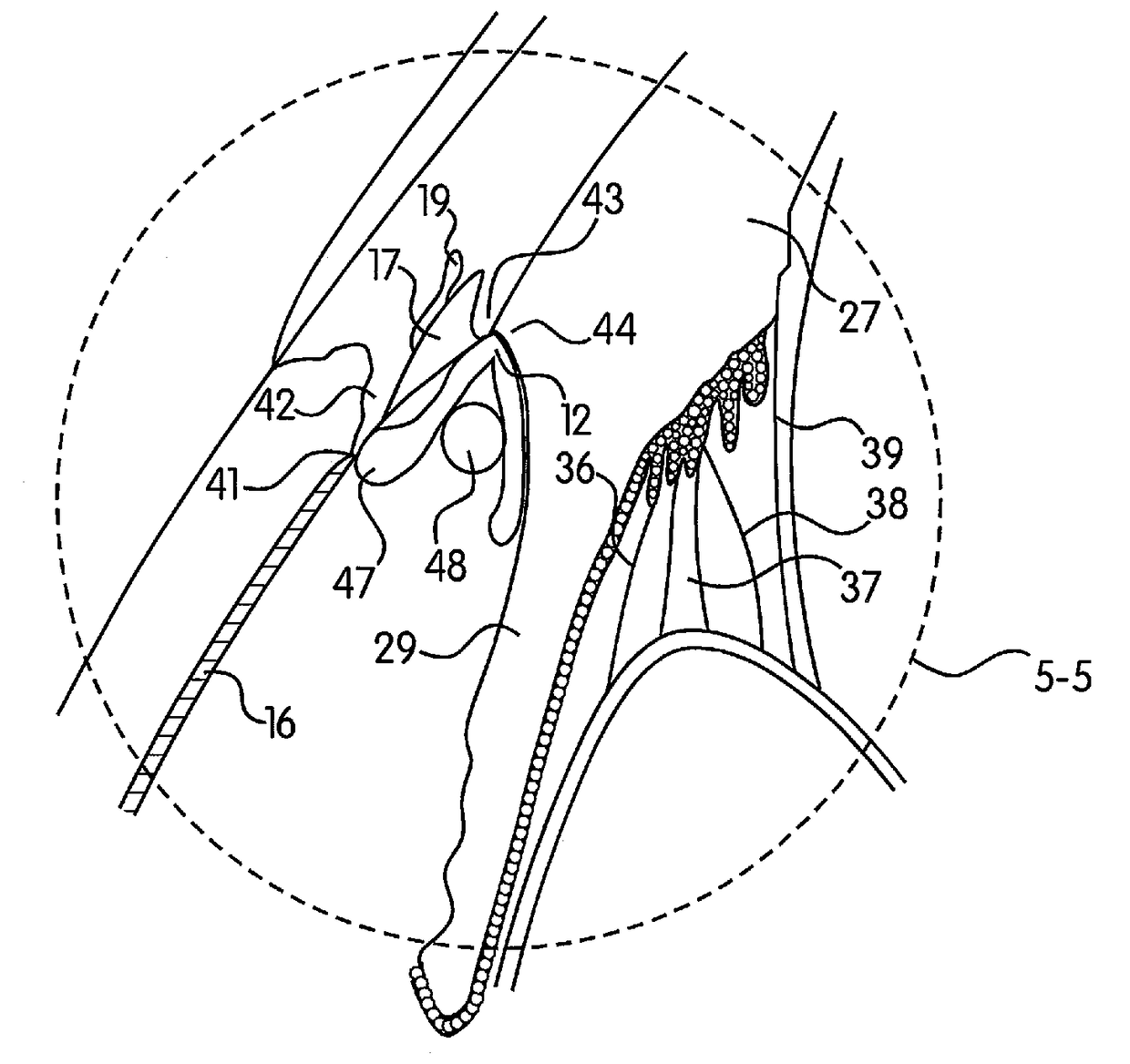 Method of reducing the occurrence of macular and neuroretinal degenerations by alleviating age related retinal stresses as a contributing factor in a mammalian eye