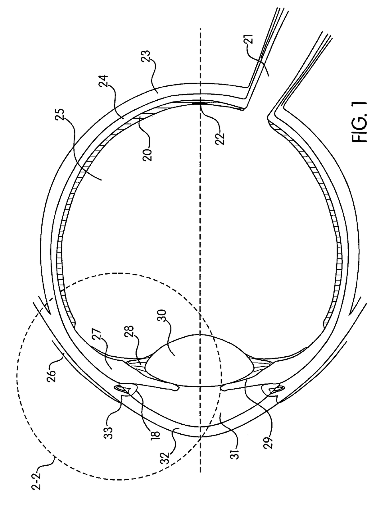 Method of reducing the occurrence of macular and neuroretinal degenerations by alleviating age related retinal stresses as a contributing factor in a mammalian eye