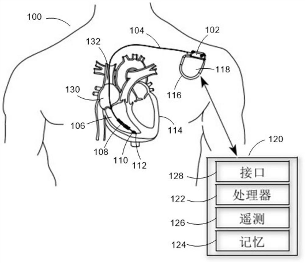 Implanted medical equipment capable of identifying ventricular fibrillation