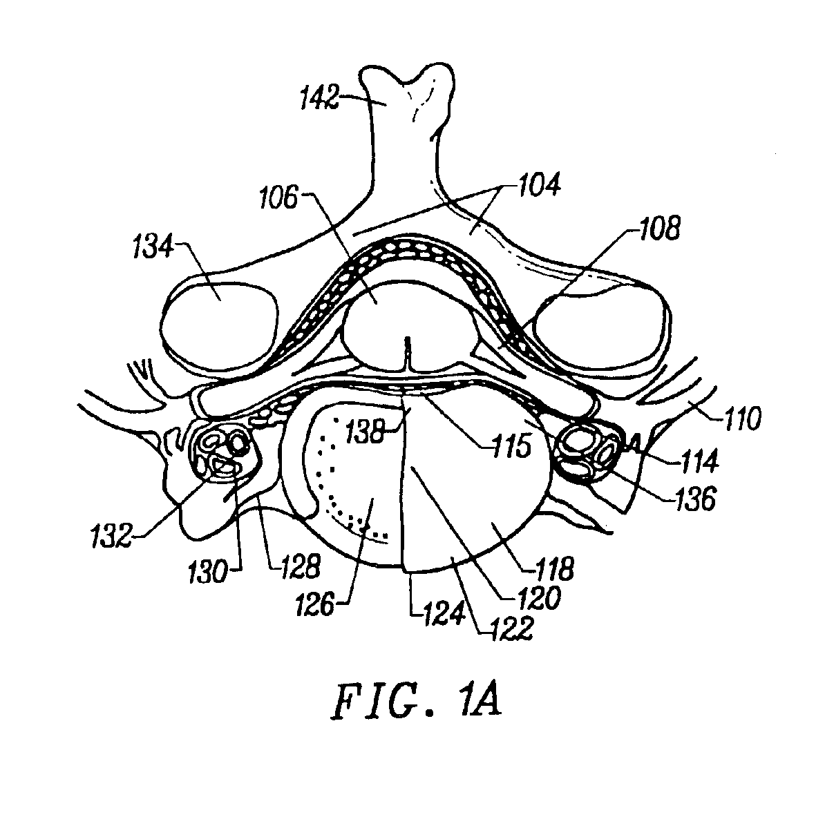 Method and apparatus for treating annular fissures in intervertebral discs