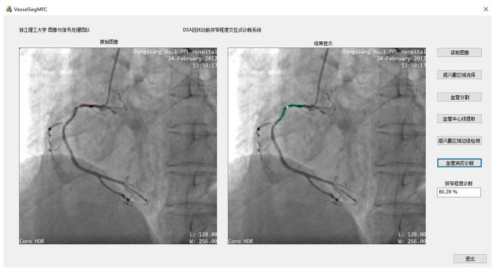 A method for identifying the degree of local vascular stenosis in dsa coronary images