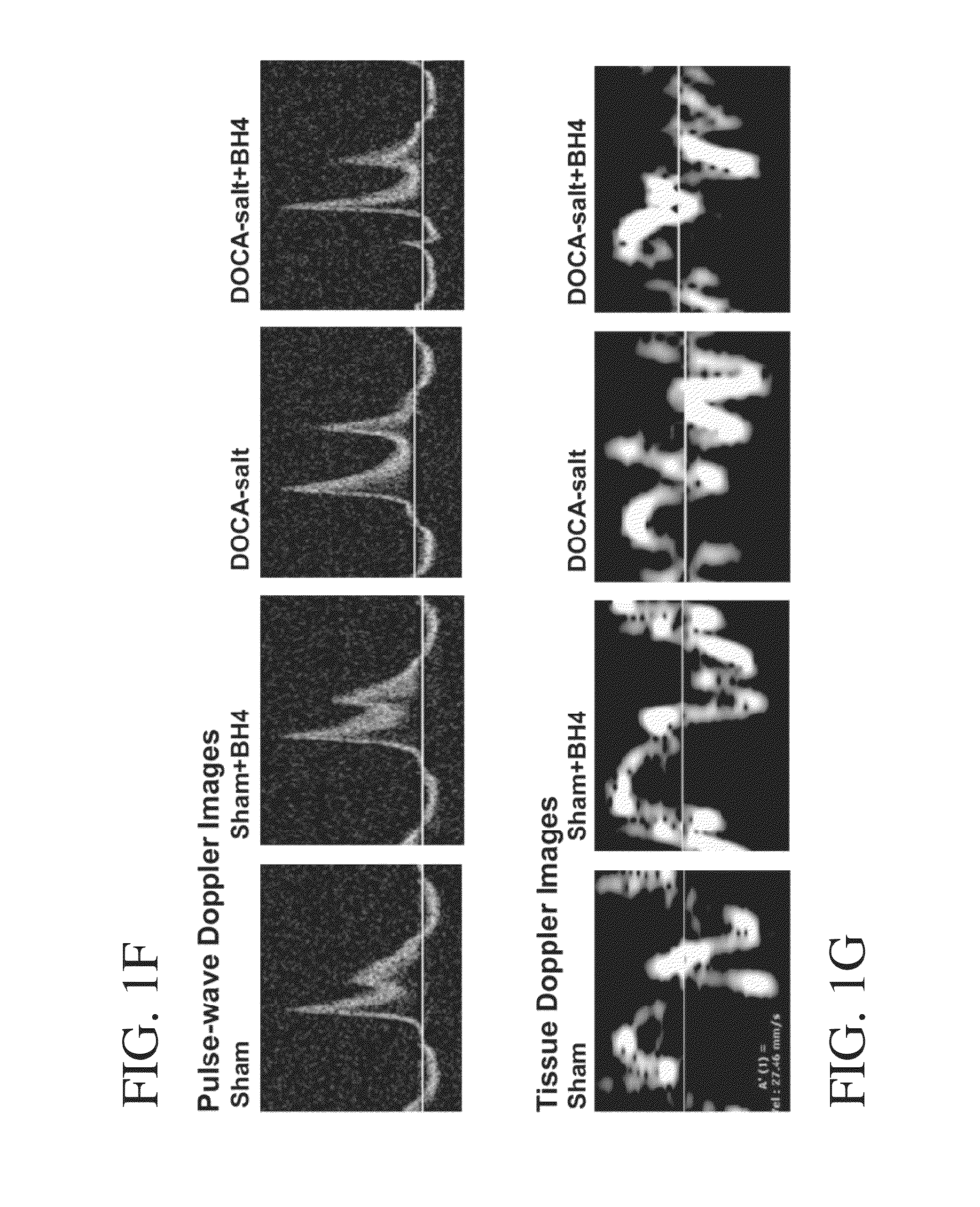 Method of improving diastolic dysfunction