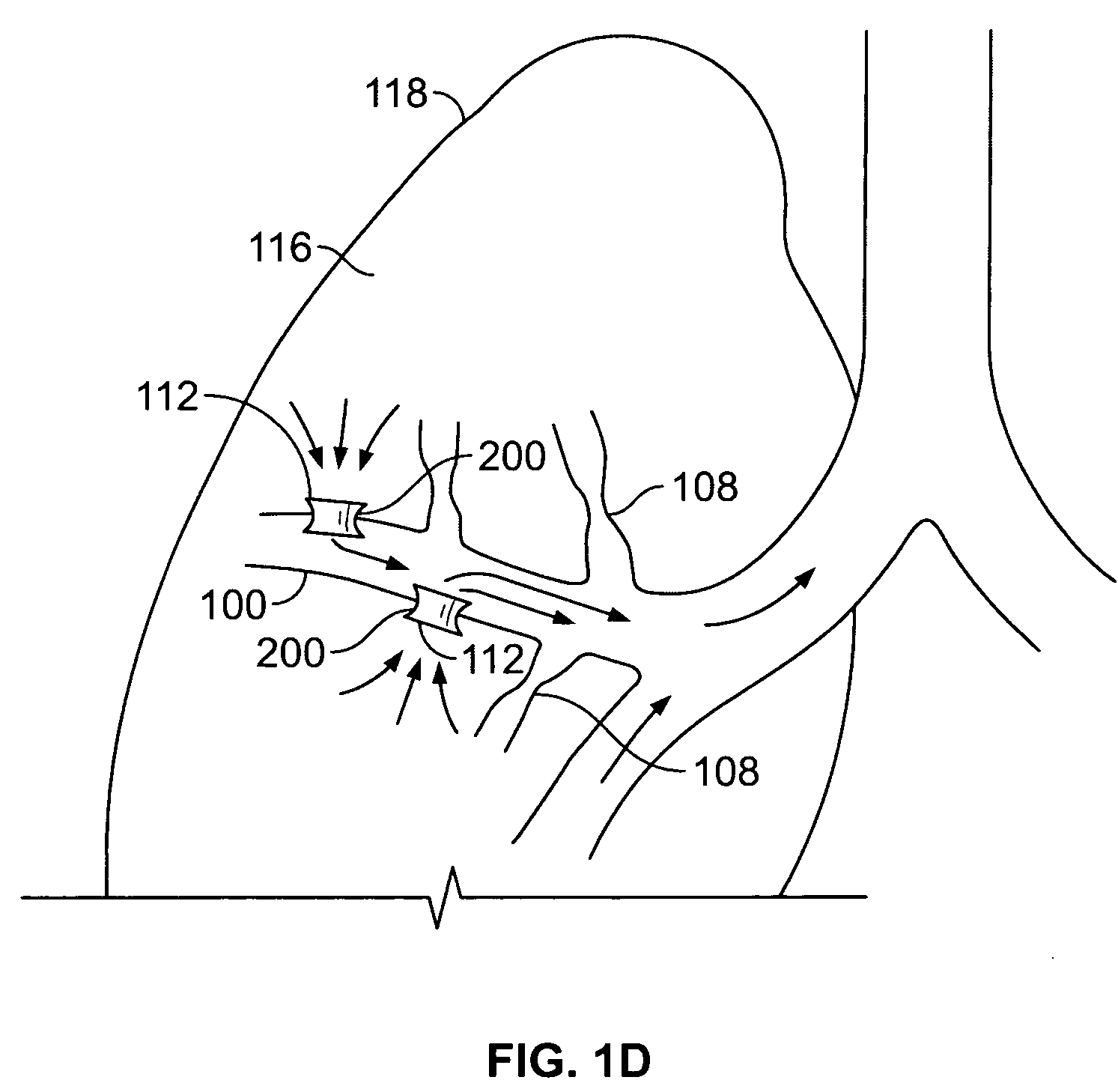 Methods and devices for maintaining surgically created channels in a body organ