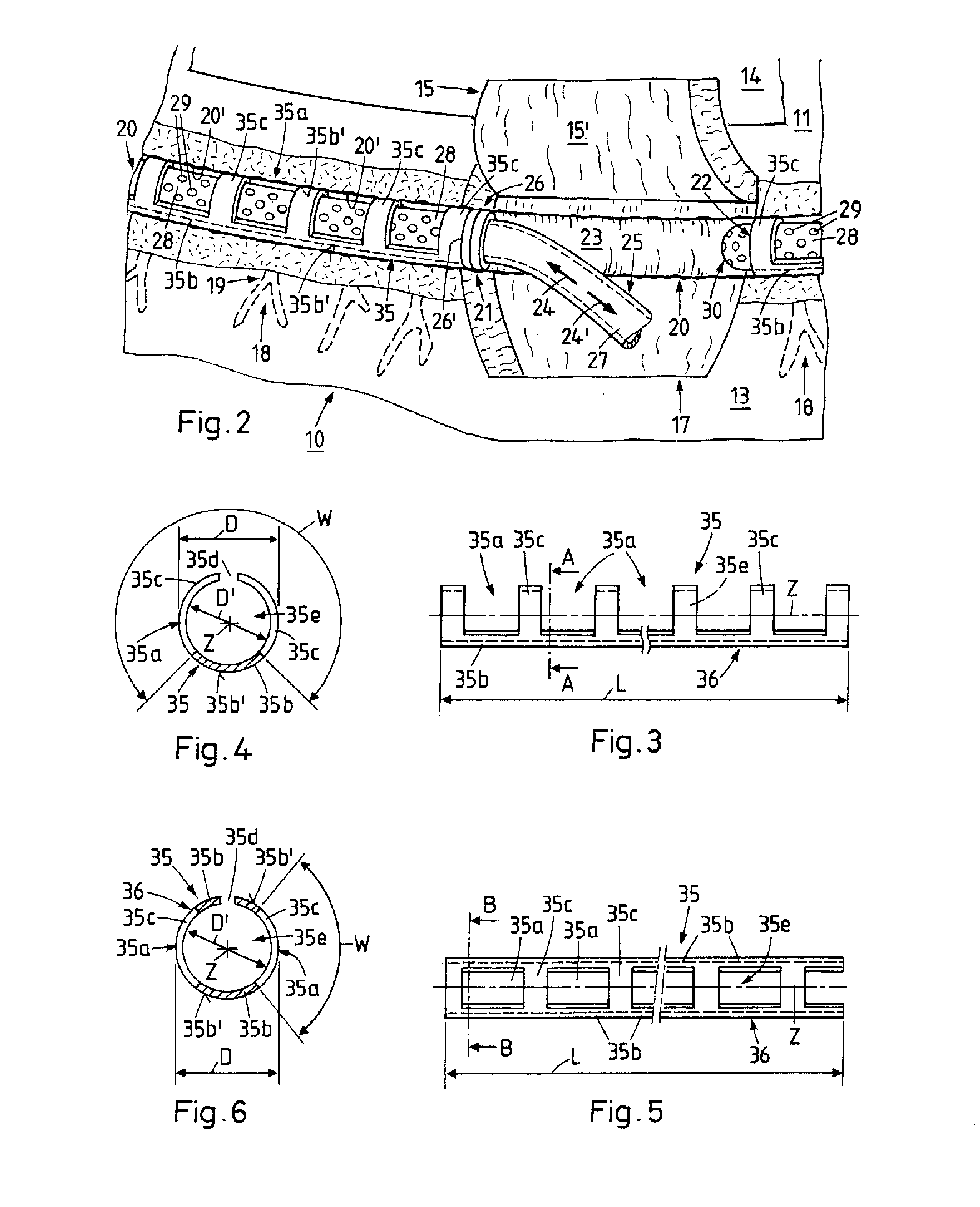 Method and device for the treatment of glaucoma