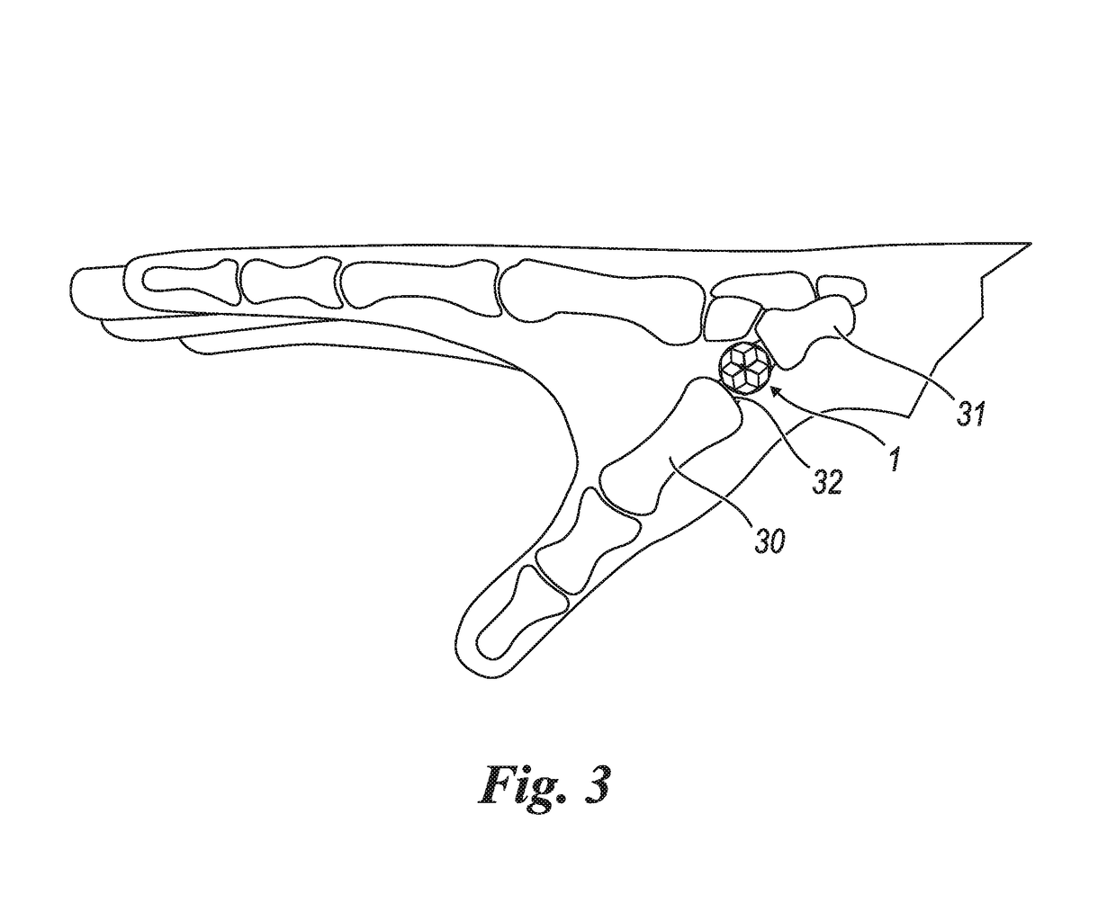 Prosthesis for the trapeze-metacarpal joint of the thumb