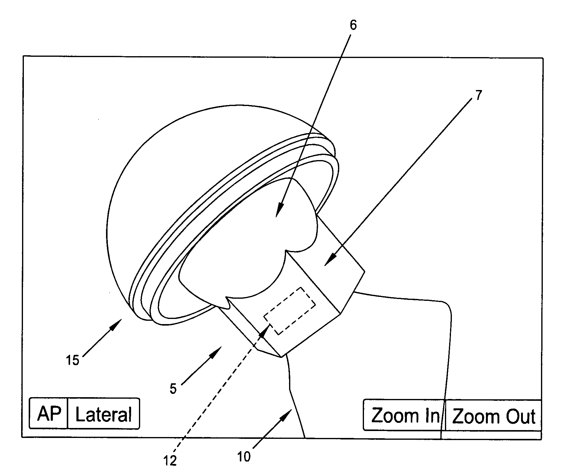 Computer-guided system for orienting the acetabular cup in the pelvis during total hip replacement surgery