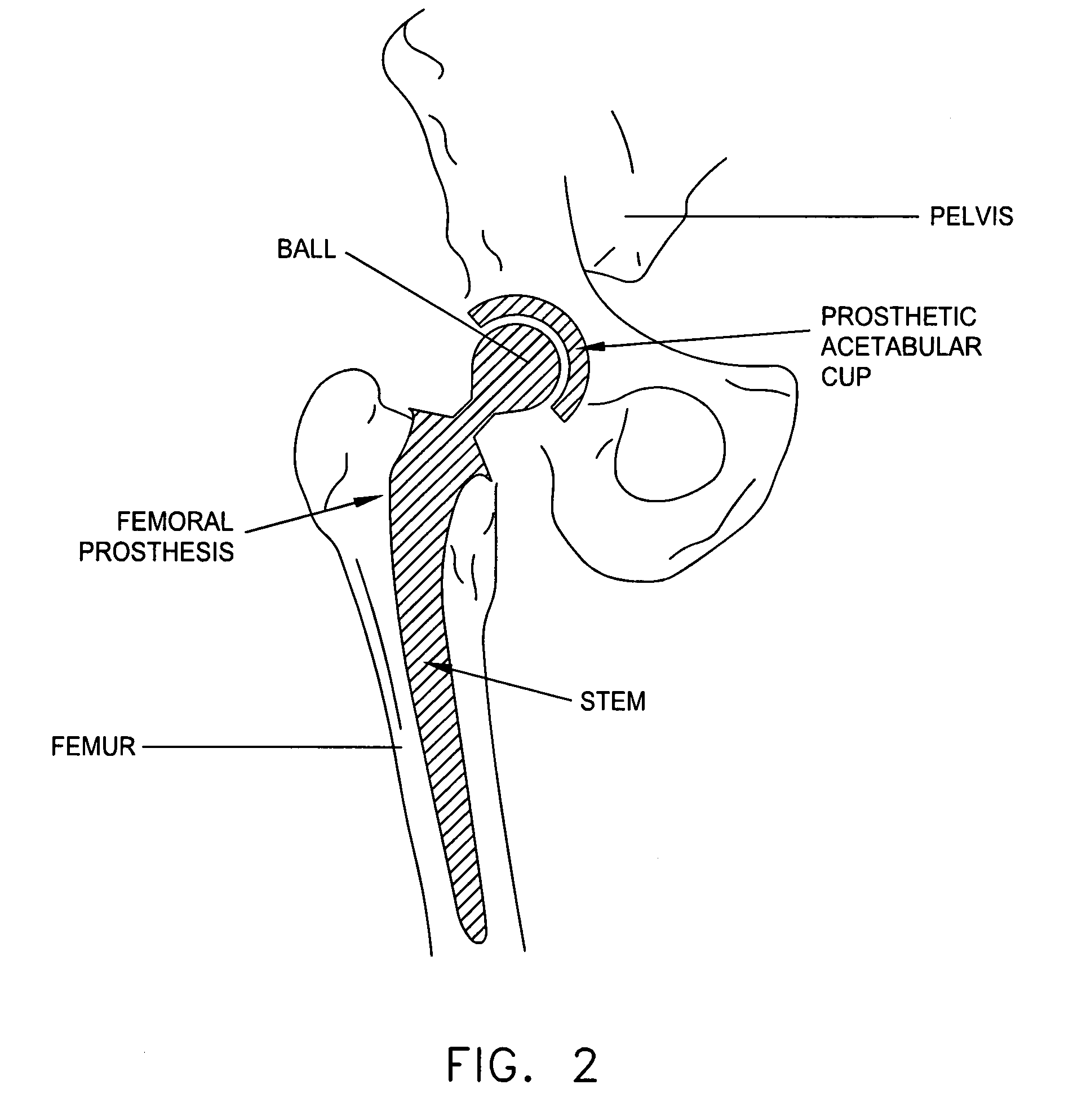 Computer-guided system for orienting the acetabular cup in the pelvis during total hip replacement surgery