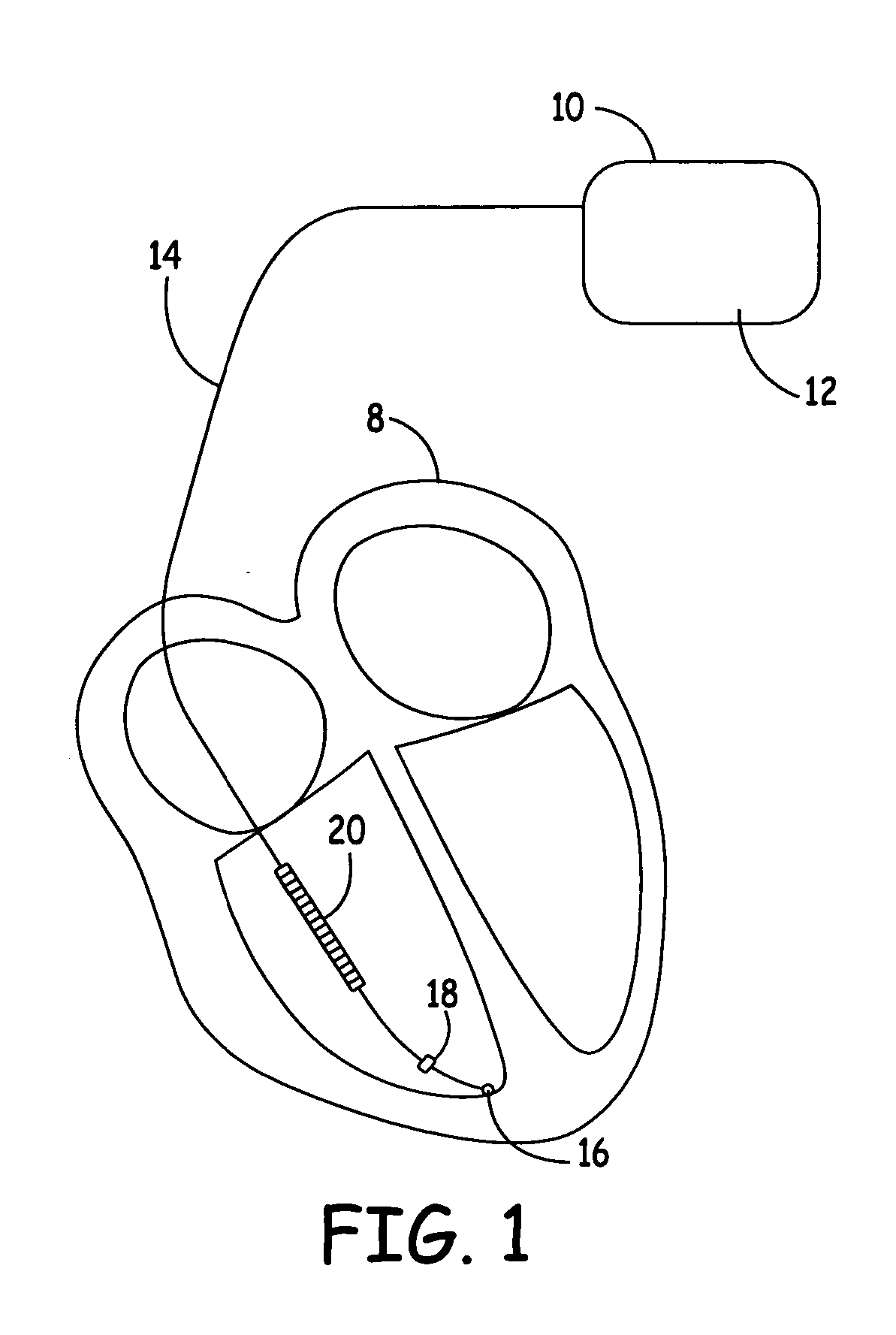 Method and apparatus for discriminating ventricular and supraventricular tachyarrhythmias