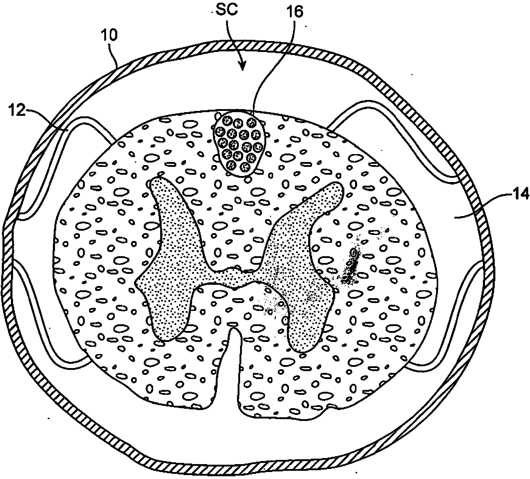 Remotely controlled and/or laterally supported devices for direct spinal cord stimulation