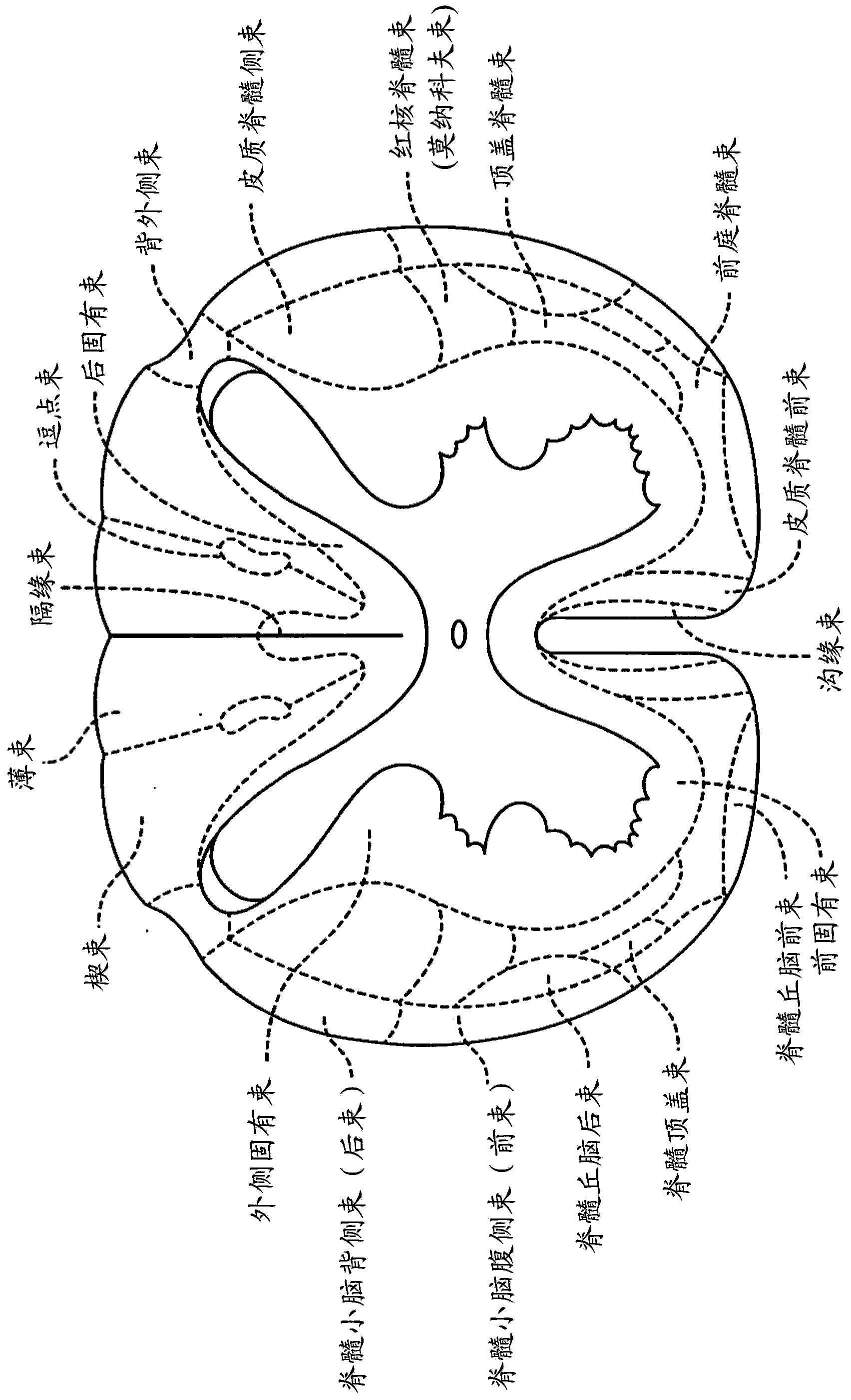 Remotely controlled and/or laterally supported devices for direct spinal cord stimulation