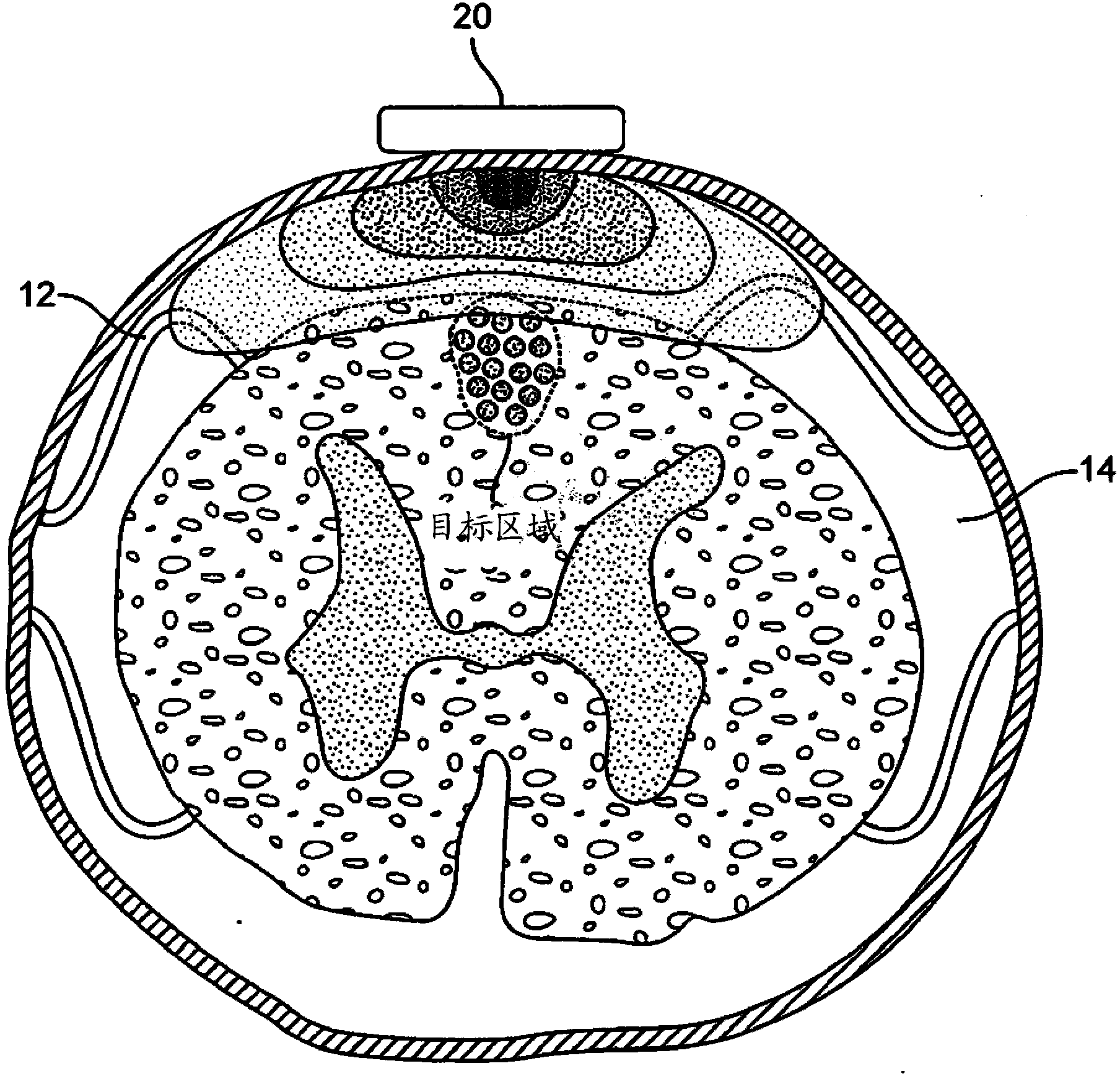 Remotely controlled and/or laterally supported devices for direct spinal cord stimulation