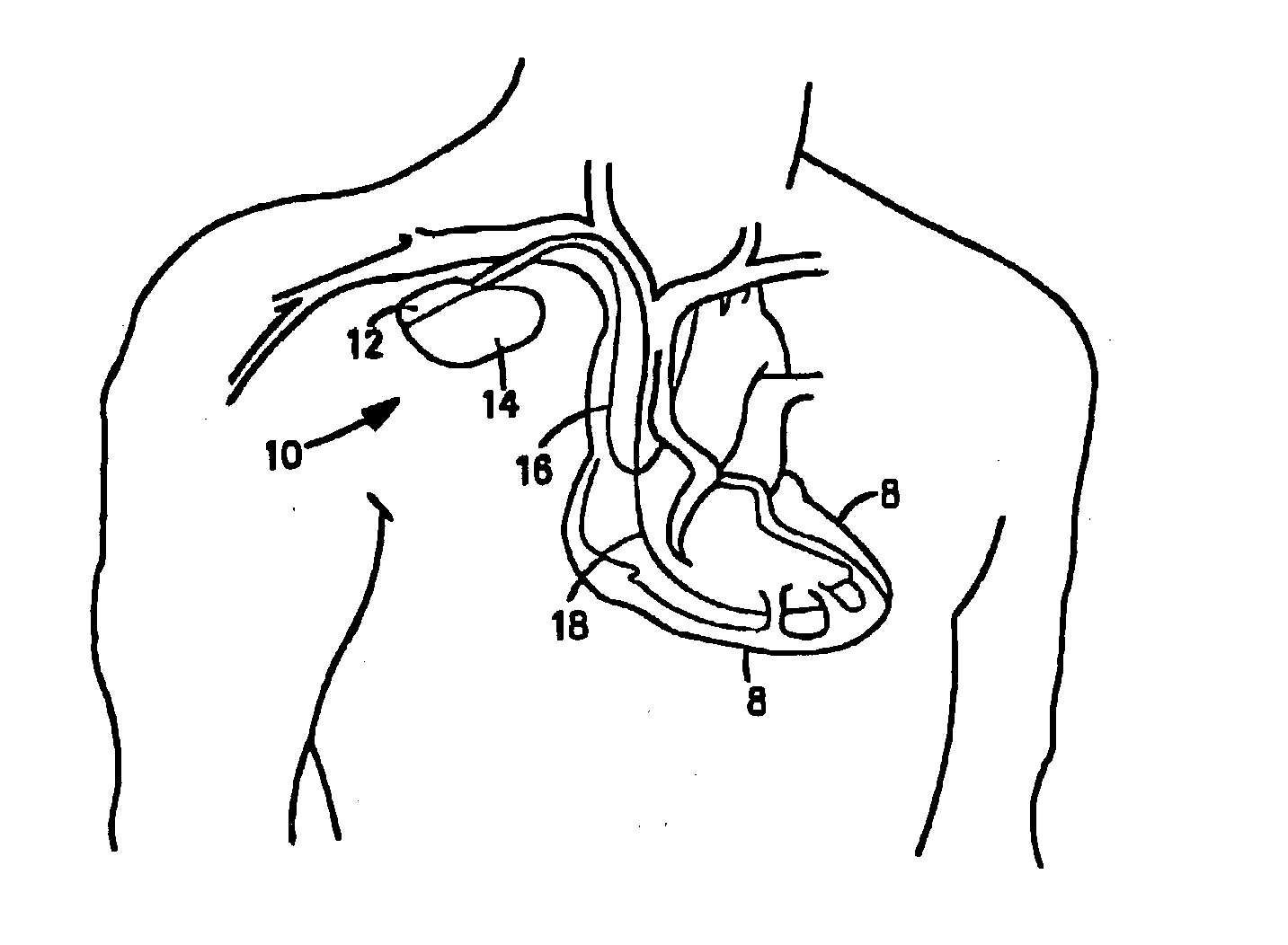 Ultrasound methods and implantable medical devices using same