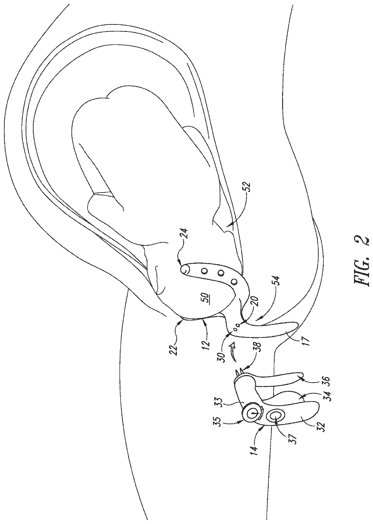 Apparatus to protect the pelvic floor during vaginal childbirth