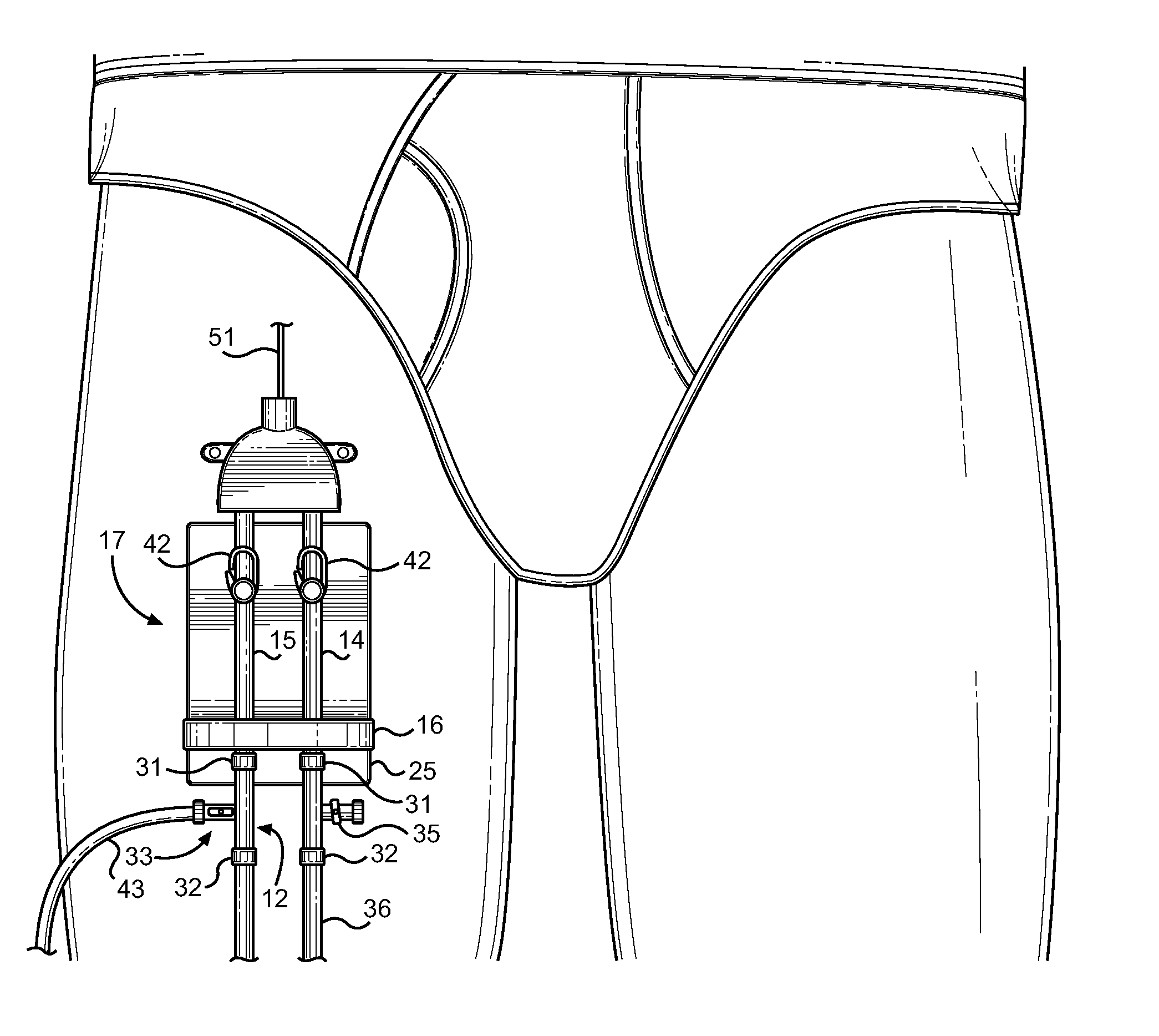 Vascular Access Catheter Anchor and Access Valve