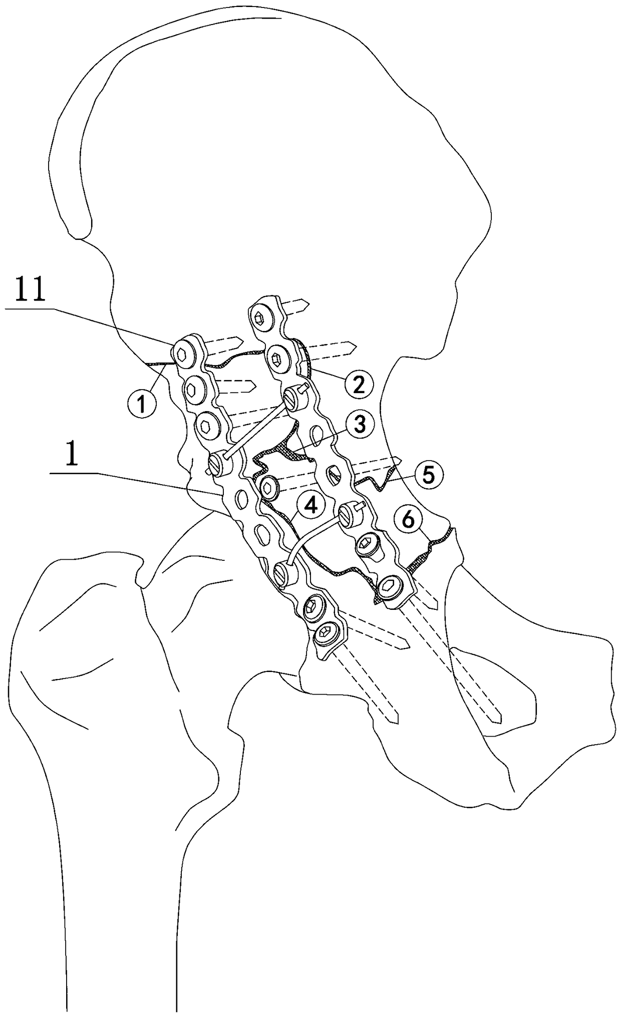 Pelvic fracture operation steel plate interlocking device