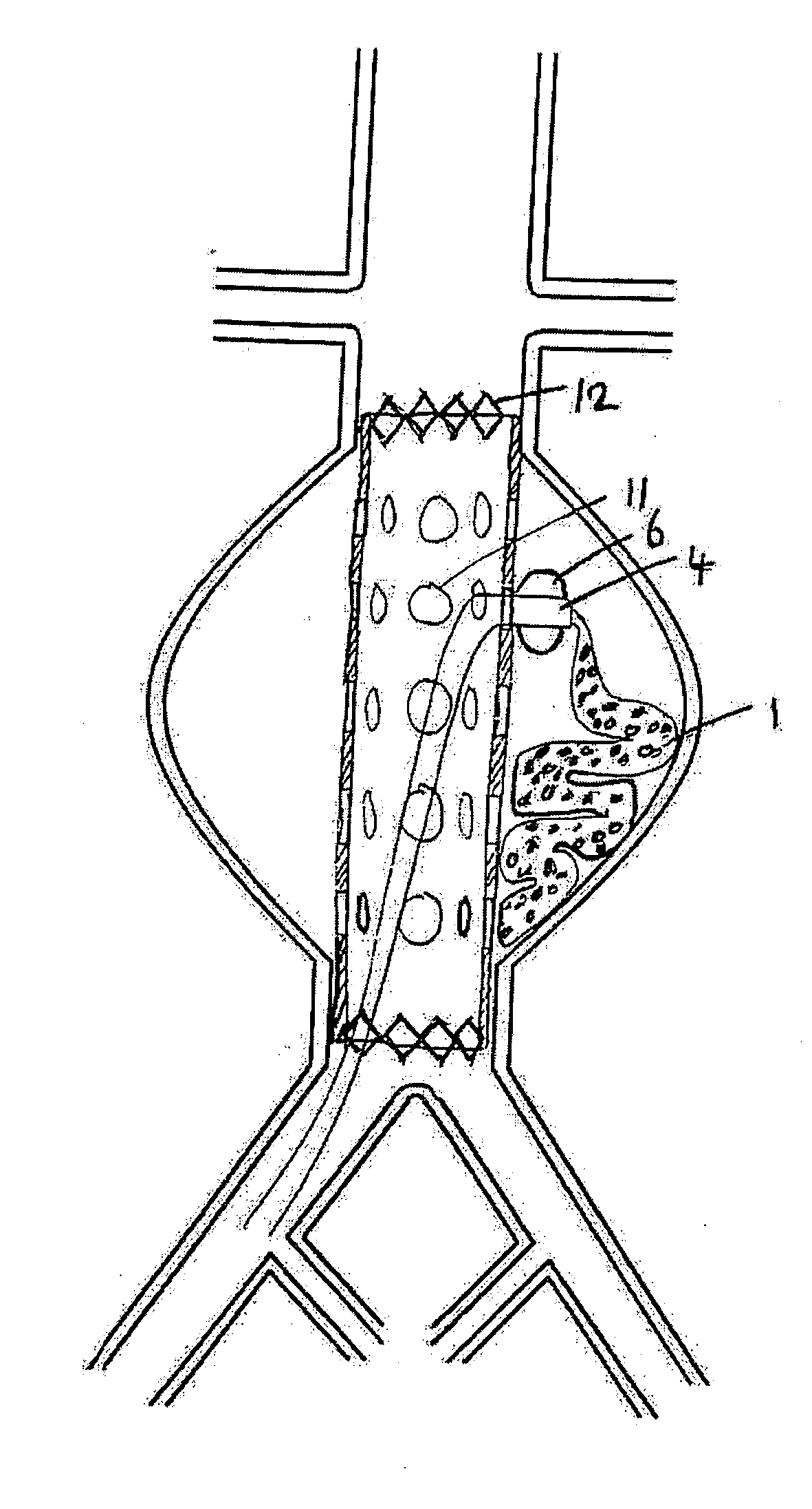 Devices and methods for treatment of vascular aneurysms