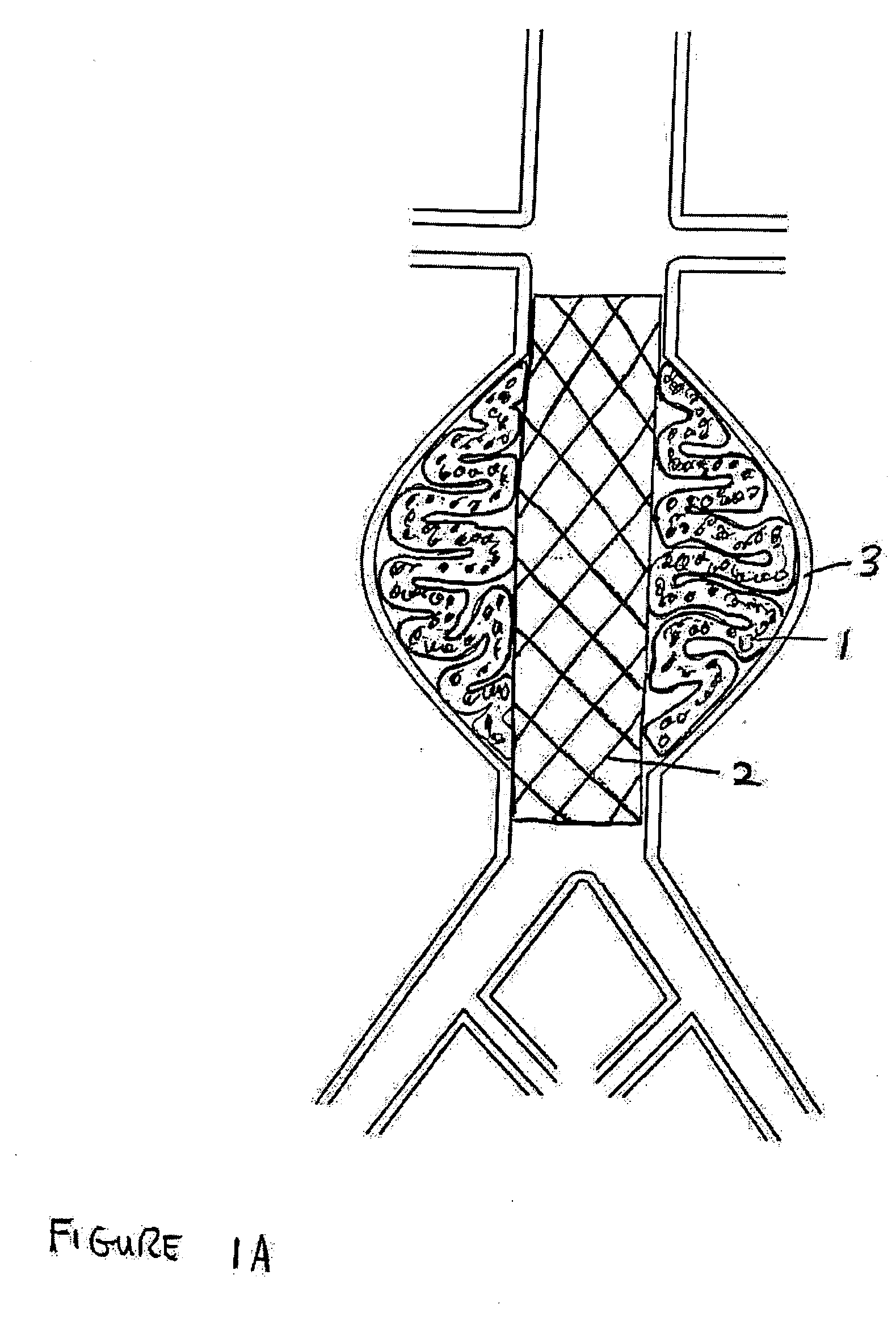 Devices and methods for treatment of vascular aneurysms