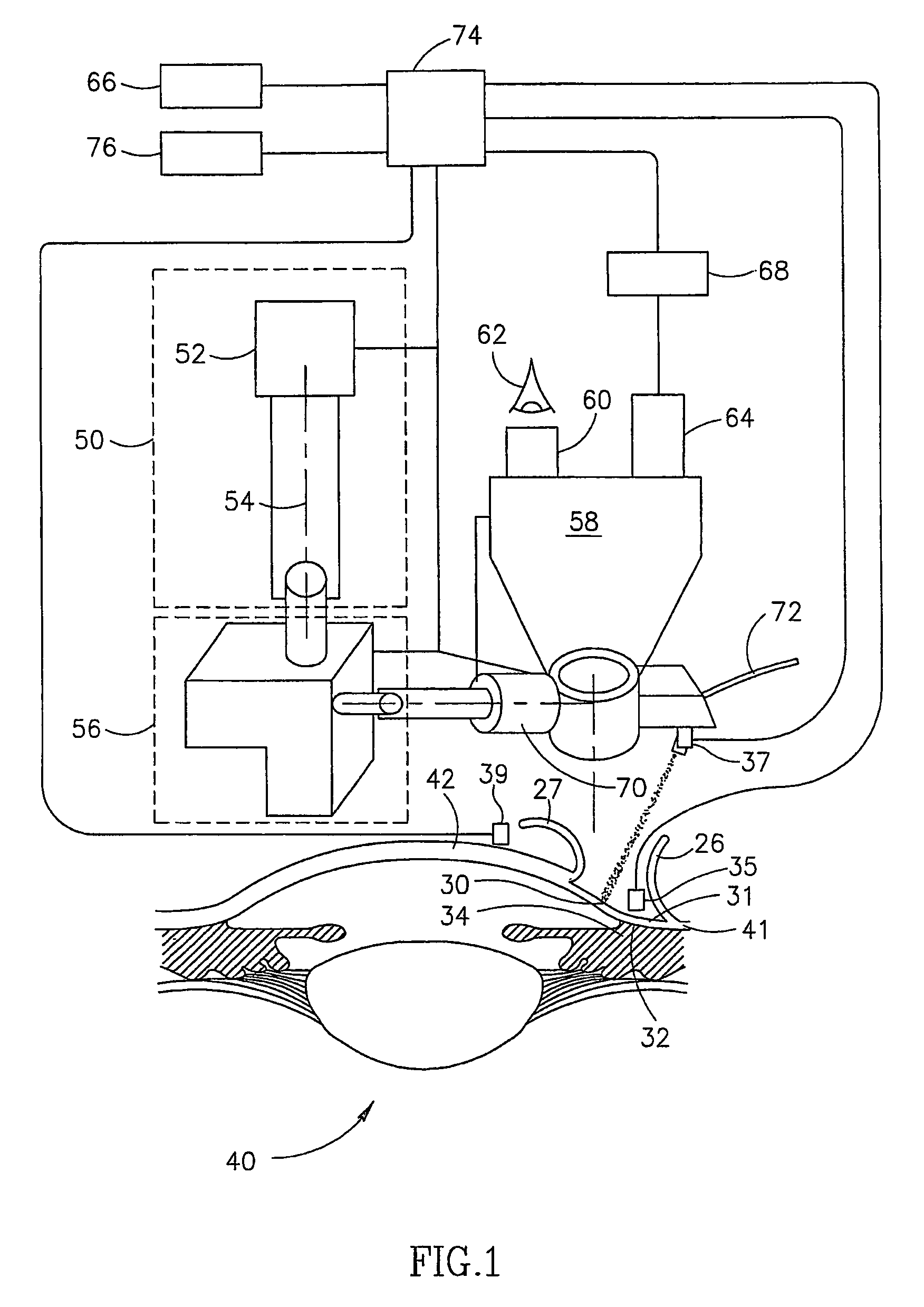 Non-penetrating filtration surgery