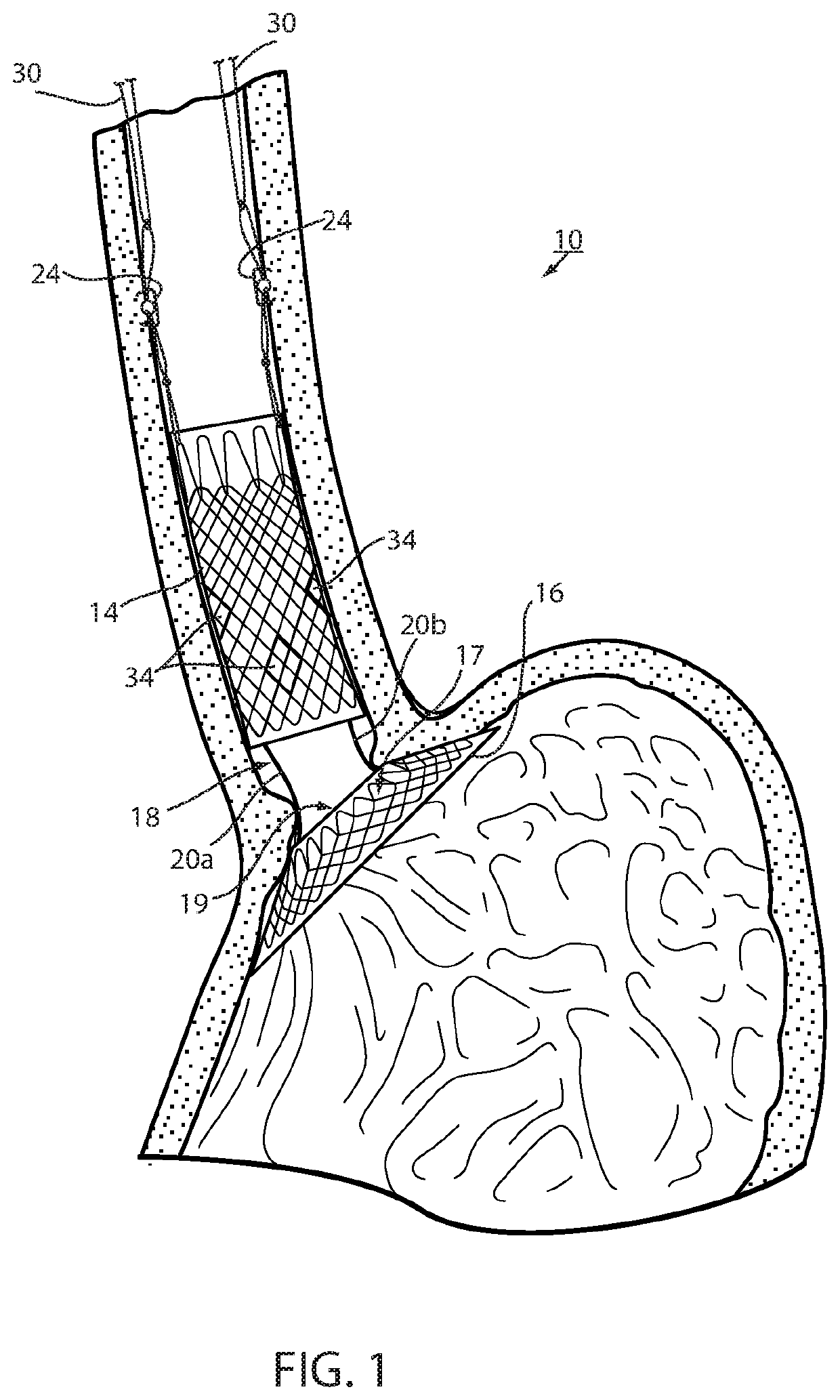 Fixation of intraluminal device