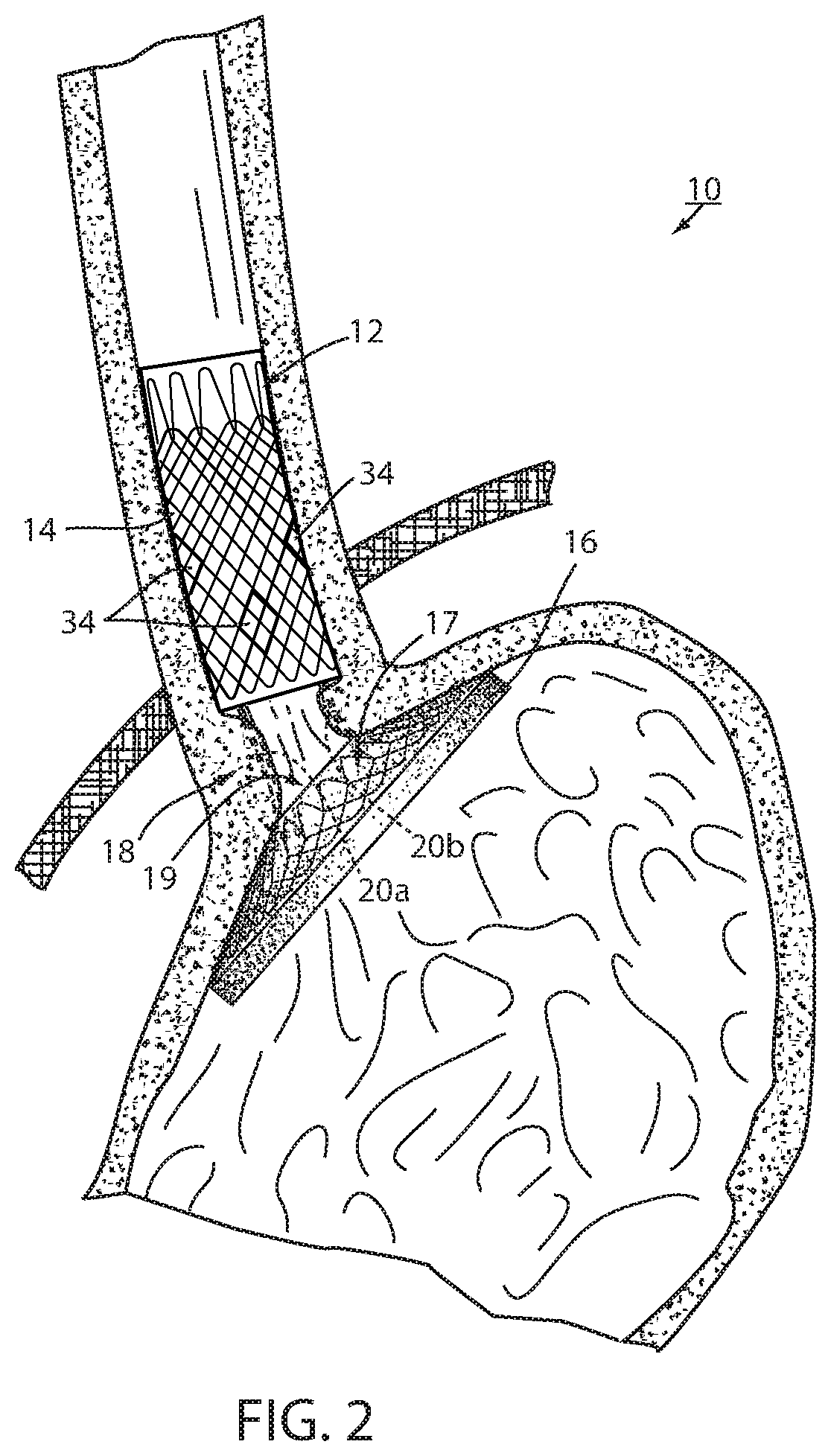 Fixation of intraluminal device