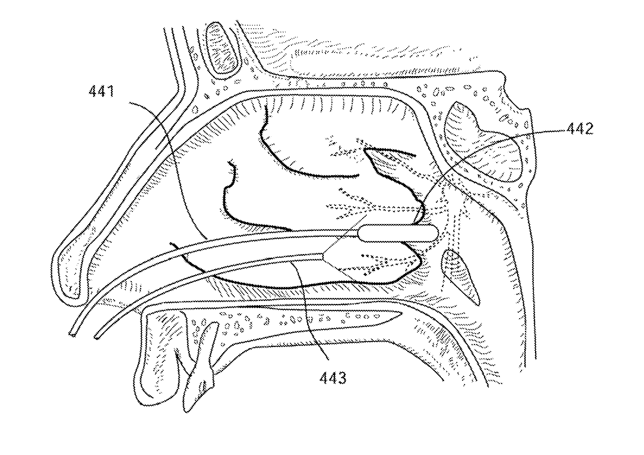 Apparatus and methods for treating rhinitis