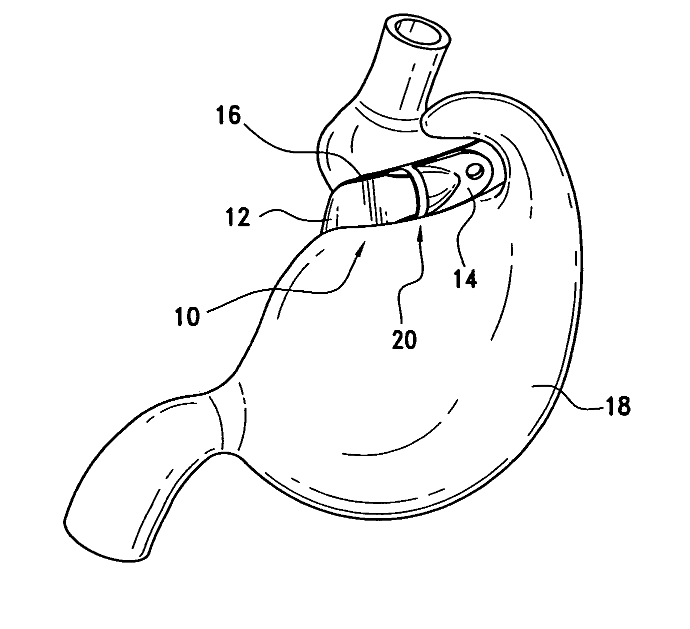 Latching device for gastric band