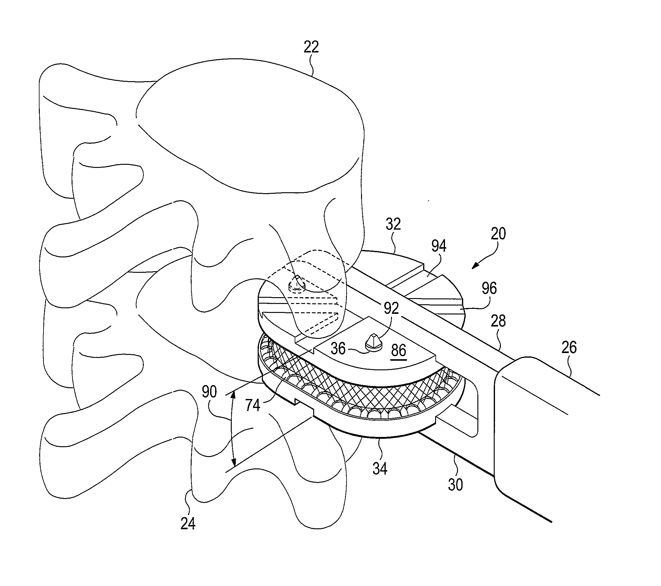 Anatomic total disc replacement