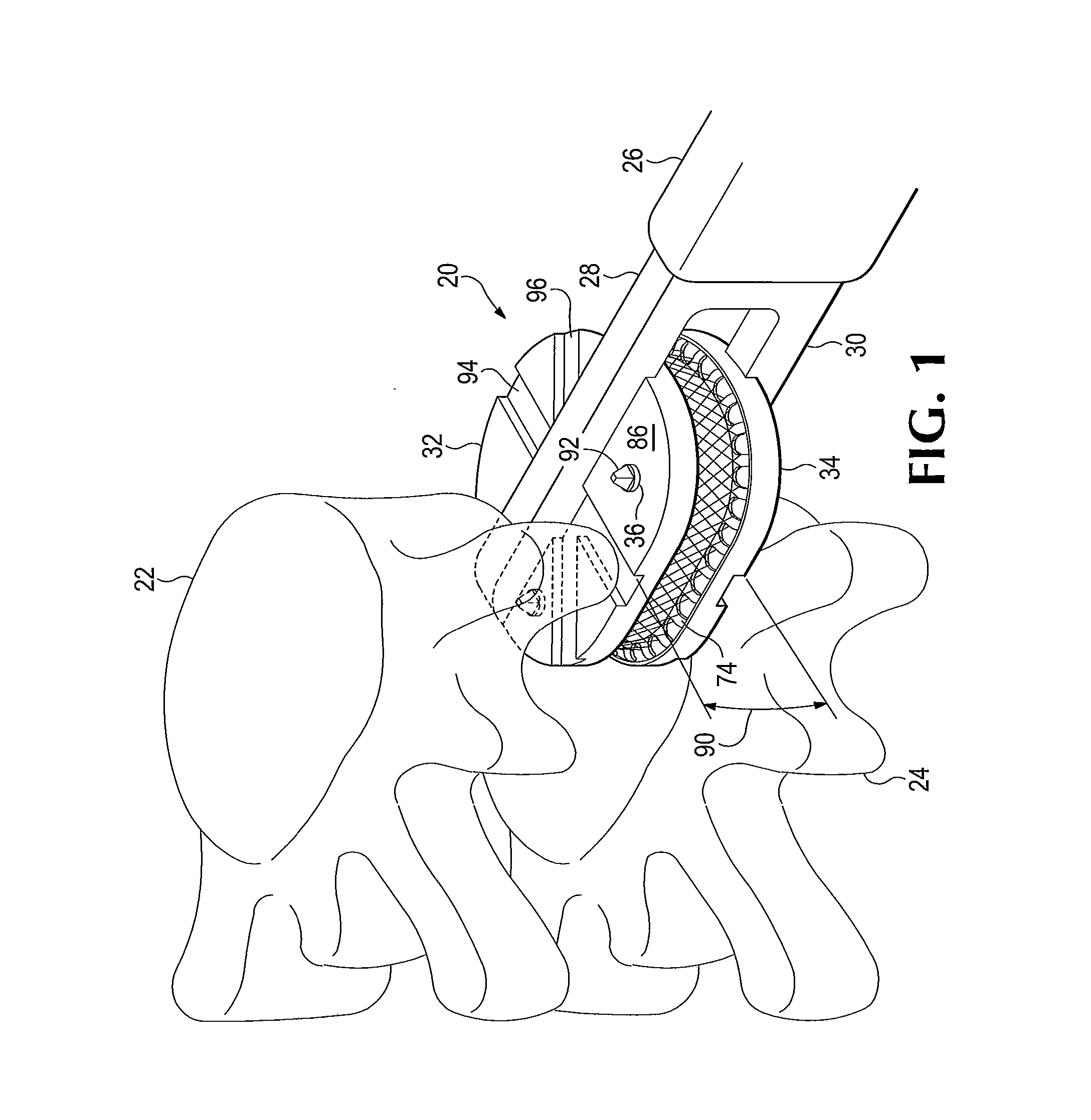 Anatomic total disc replacement