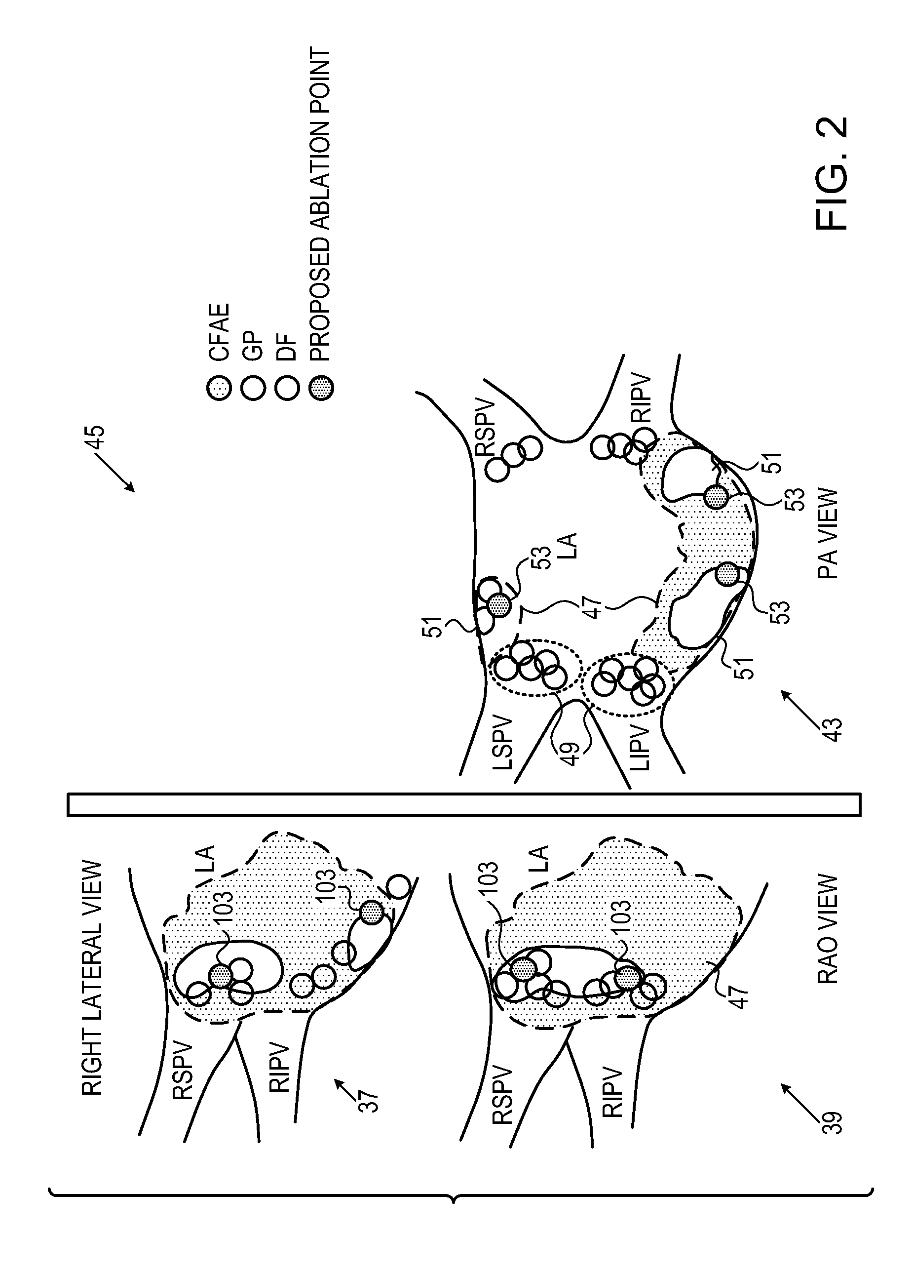 Integrative atrial fibrillation ablation