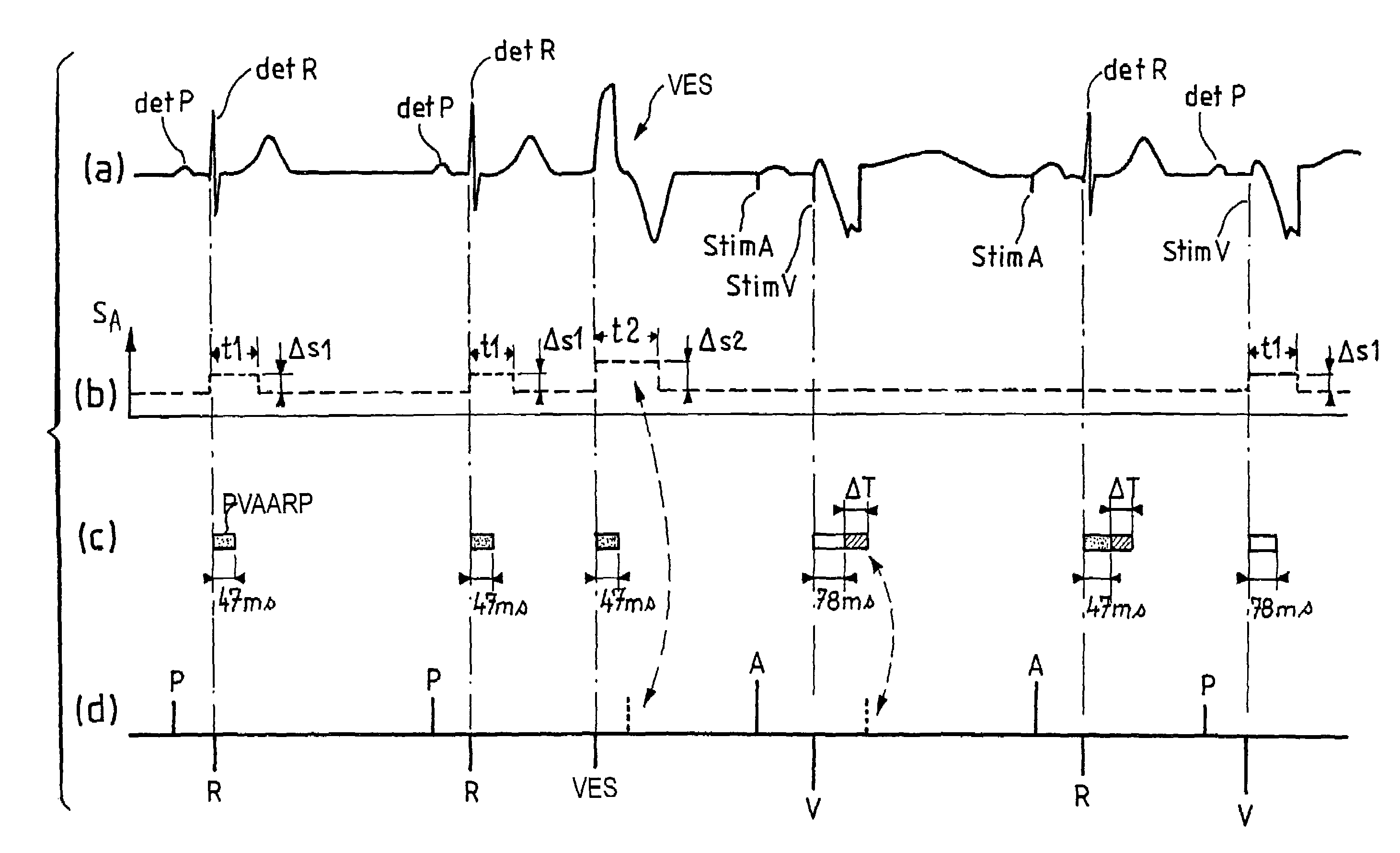 Atrial arrhythmia detection for an active implantable medical device